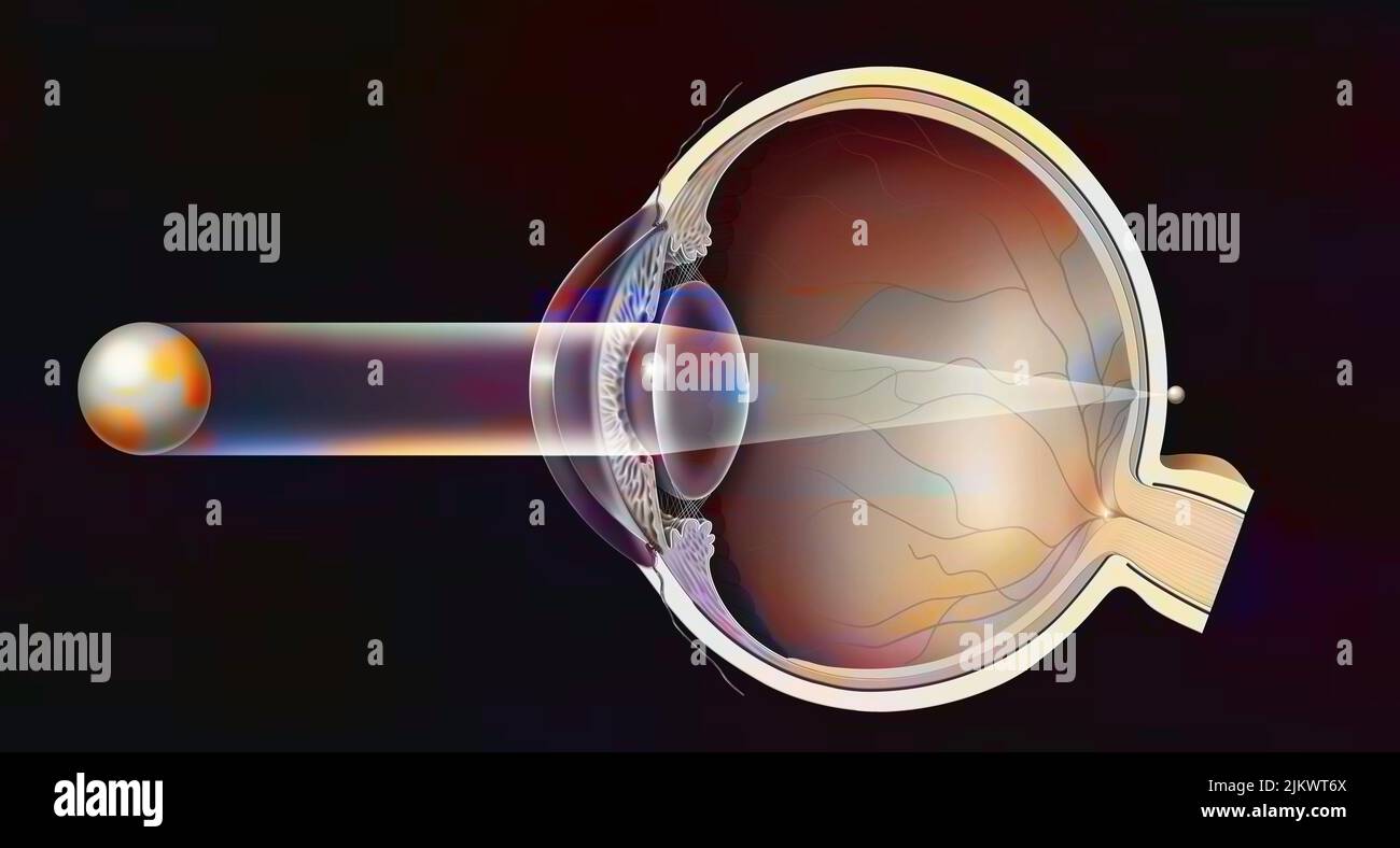 Hyperopisches Auge mit der Bildung des Bildes hinter der Netzhaut. Stockfoto