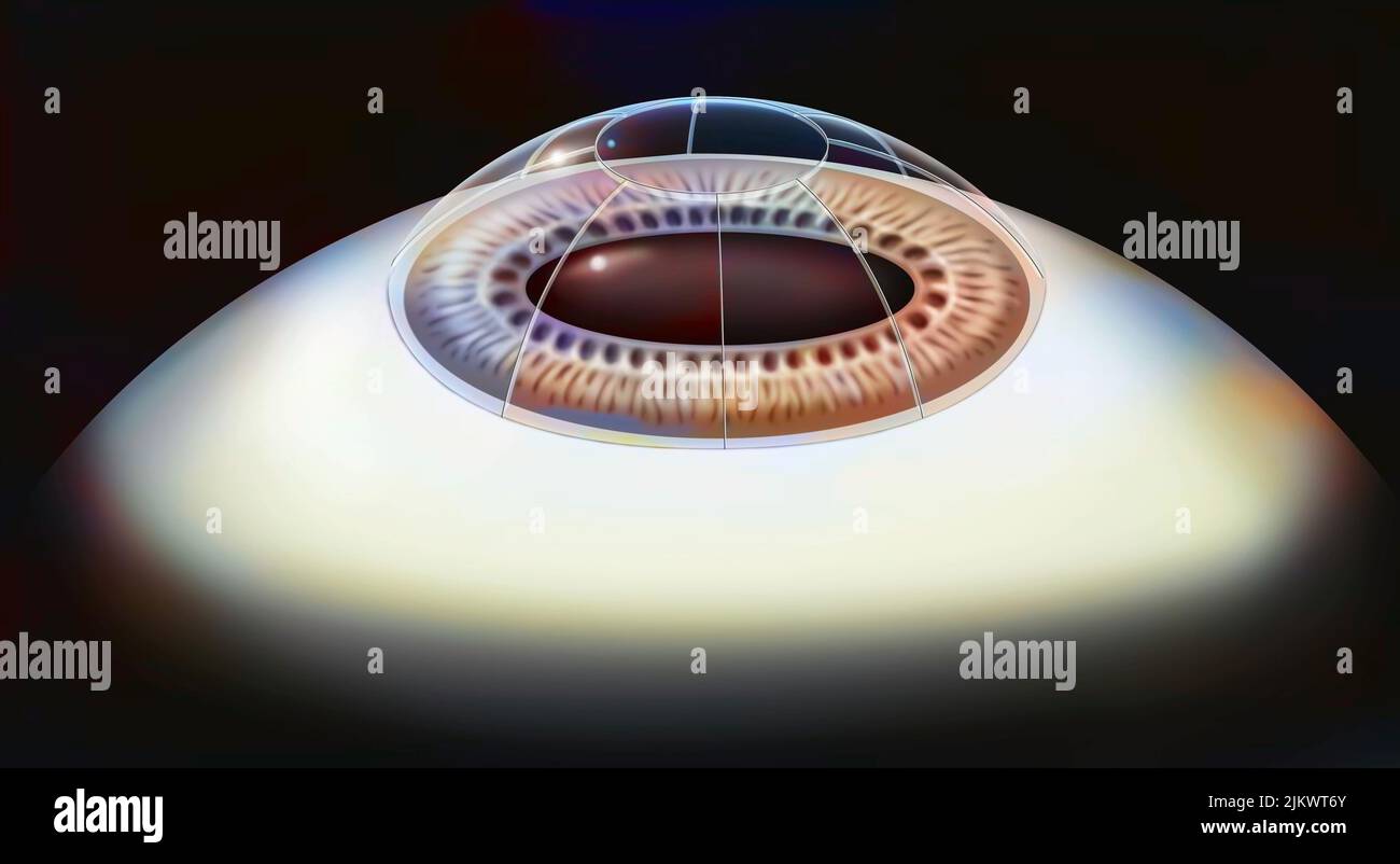 Augen, Chirurgie, radiale Keratotomie: Hornhauteinschnitte mit einem Diamantmesser. Stockfoto