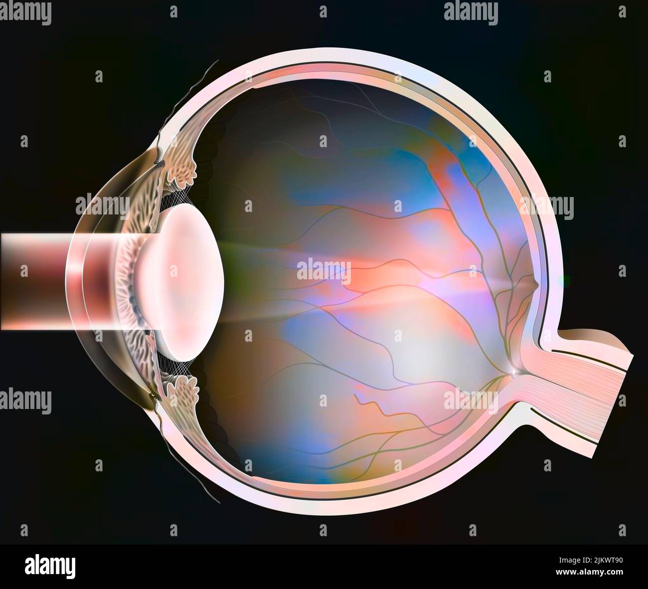 Auge: Katarakt mit seiner trüben, milchigen Linse. Stockfoto