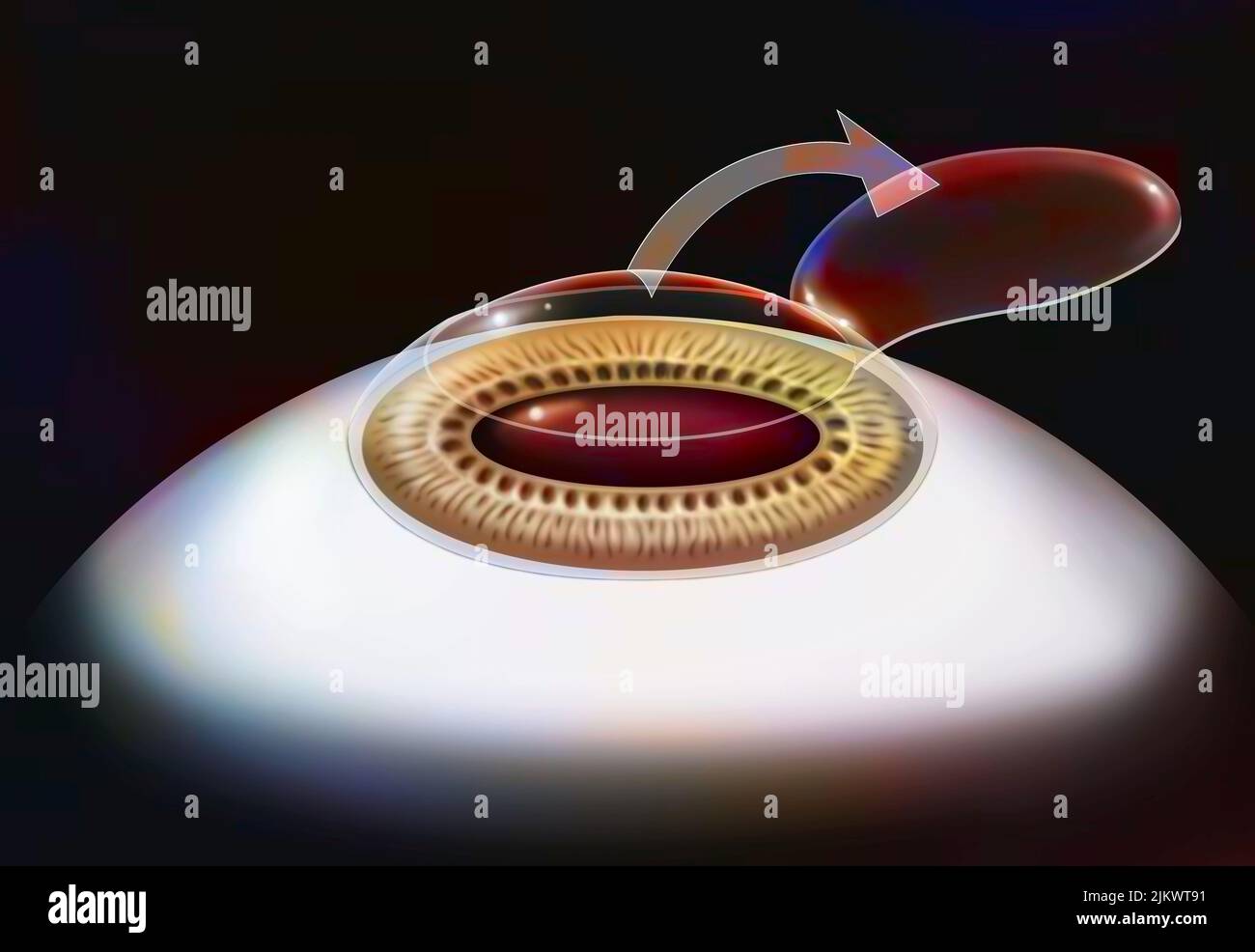 Auge, Operation, Lasik Schritt 2: Die Hornhautklappe wird angehoben. Stockfoto