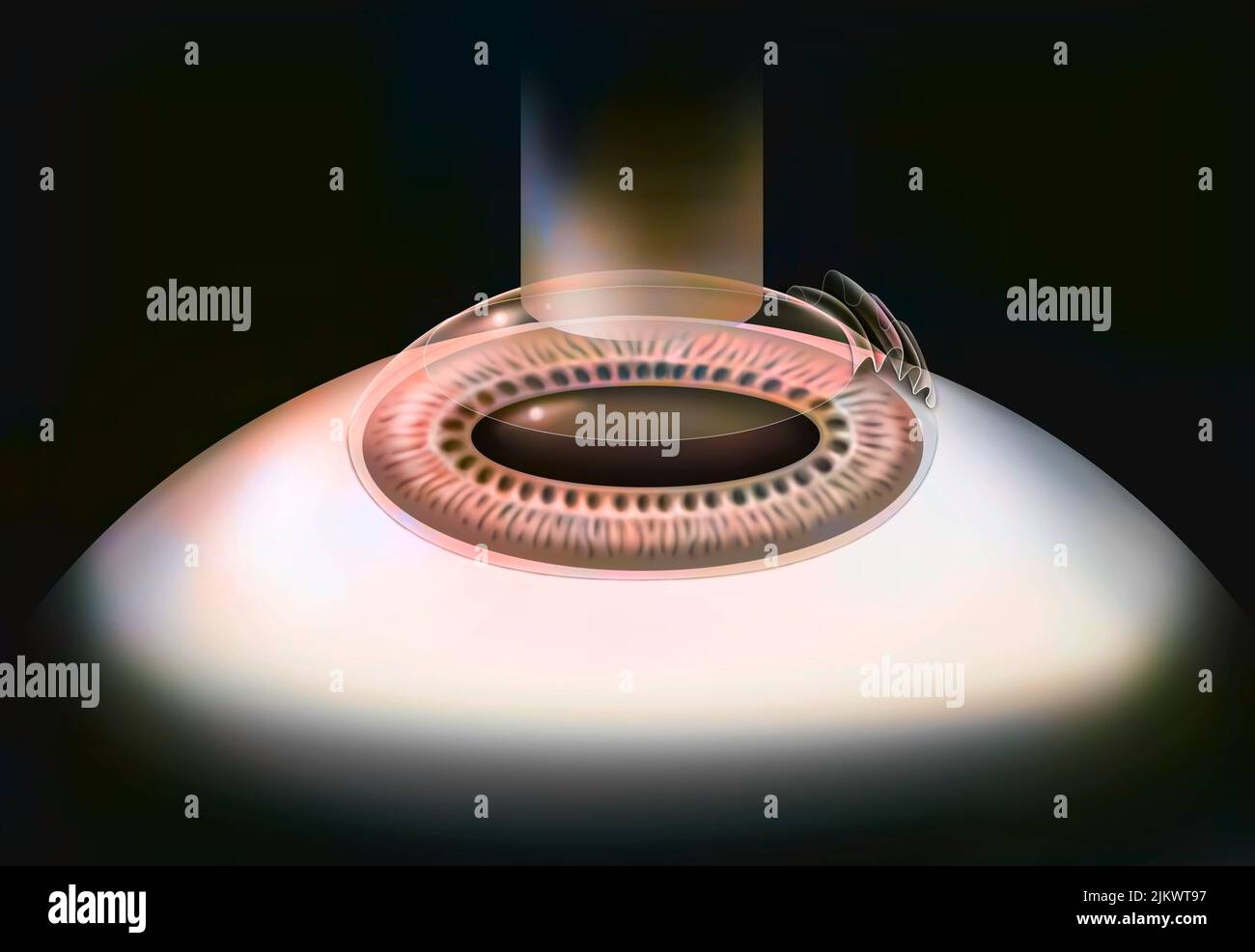 Auge, Chirurgie, Lasek Schritt 3: Die Hornhaut wird mit dem Eximer-Laser neu geformt. Stockfoto