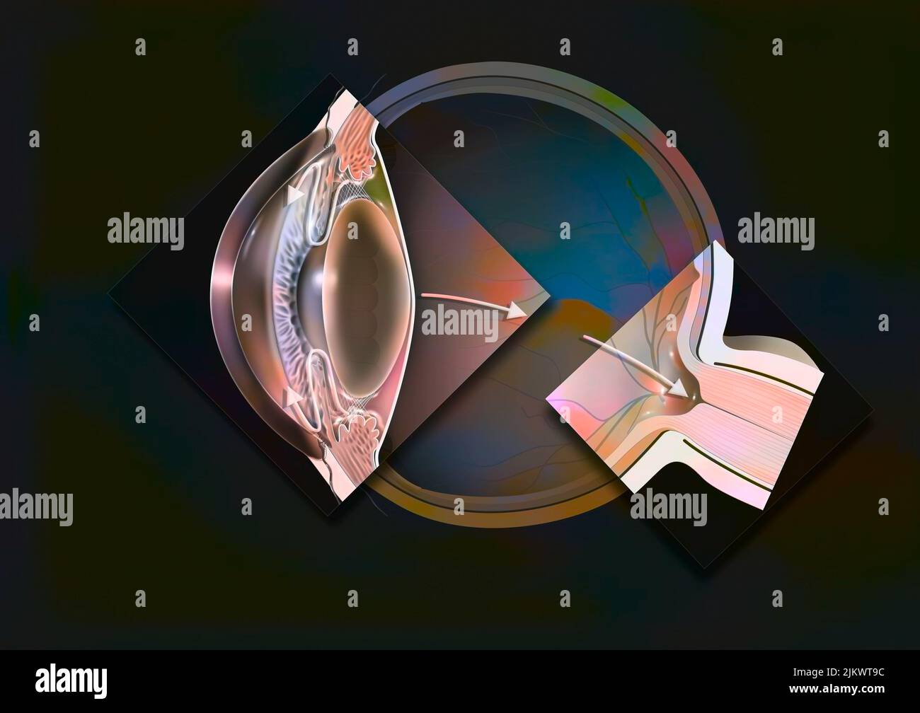 Glaukomatöses Auge mit Zoomen eines Offenwinkelglaukoms und einer glaukomatösen Papille. Stockfoto