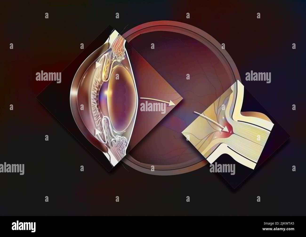 Glaukomatöses Auge mit Zoomen eines Offenwinkelglaukoms und einer glaukomatösen Papille. Stockfoto