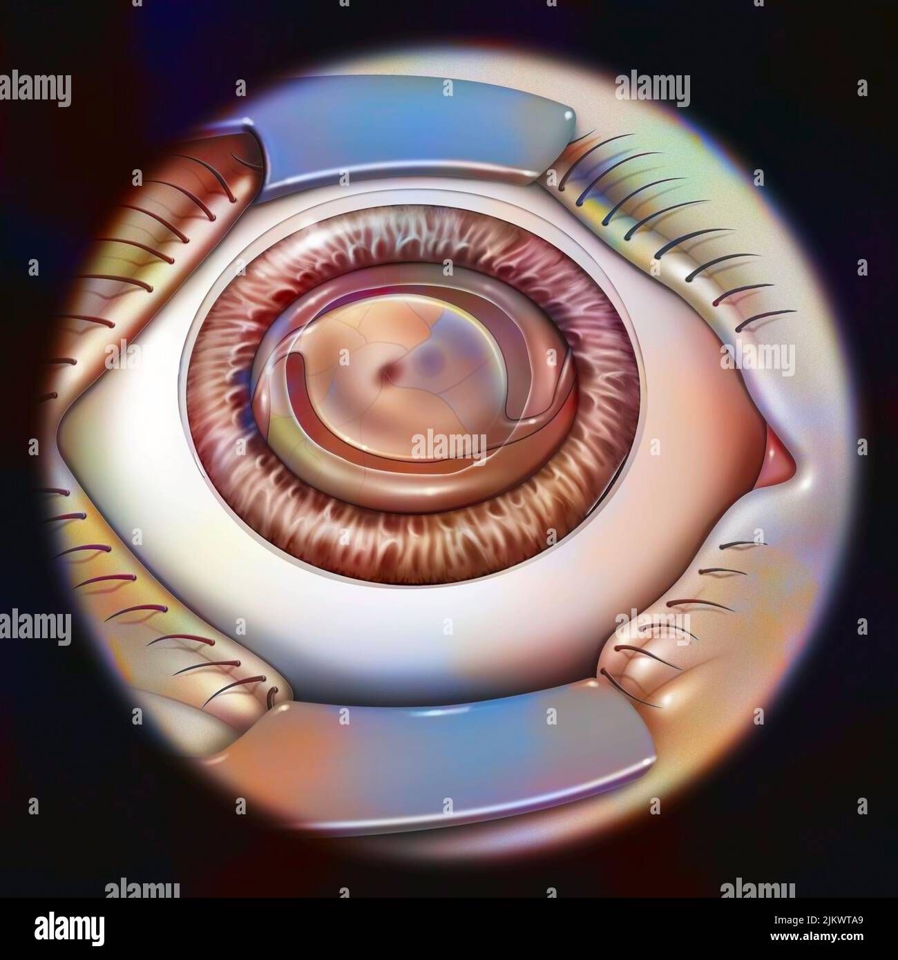 Auge, Katarakt, Phakoemulsifikation - Schritt 4: Das Implantat befindet sich im Kapselsack. Stockfoto