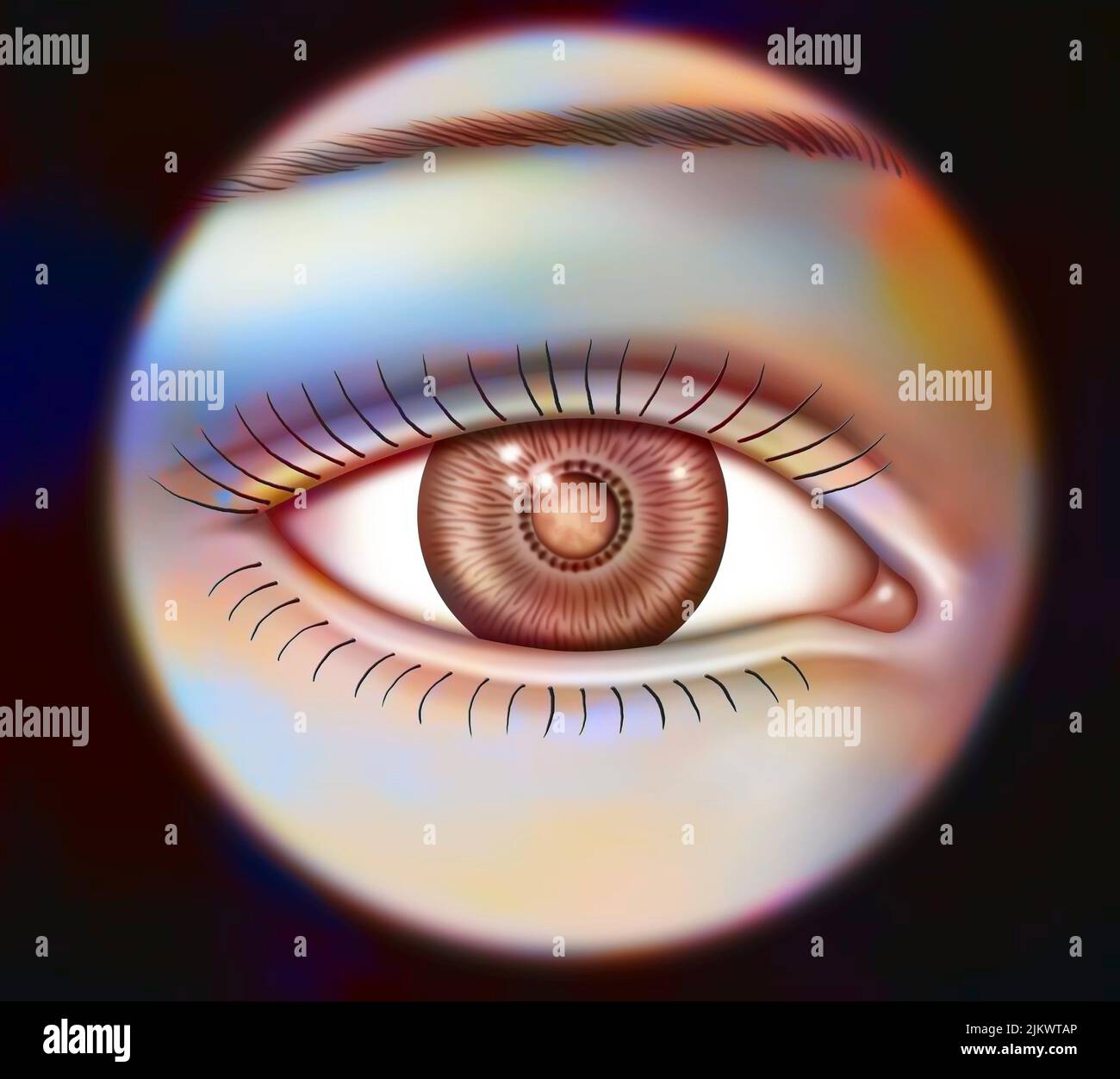Auge: Mäßig opazifizierte Pupille im Kontext einer moderaten Katarakt. Stockfoto