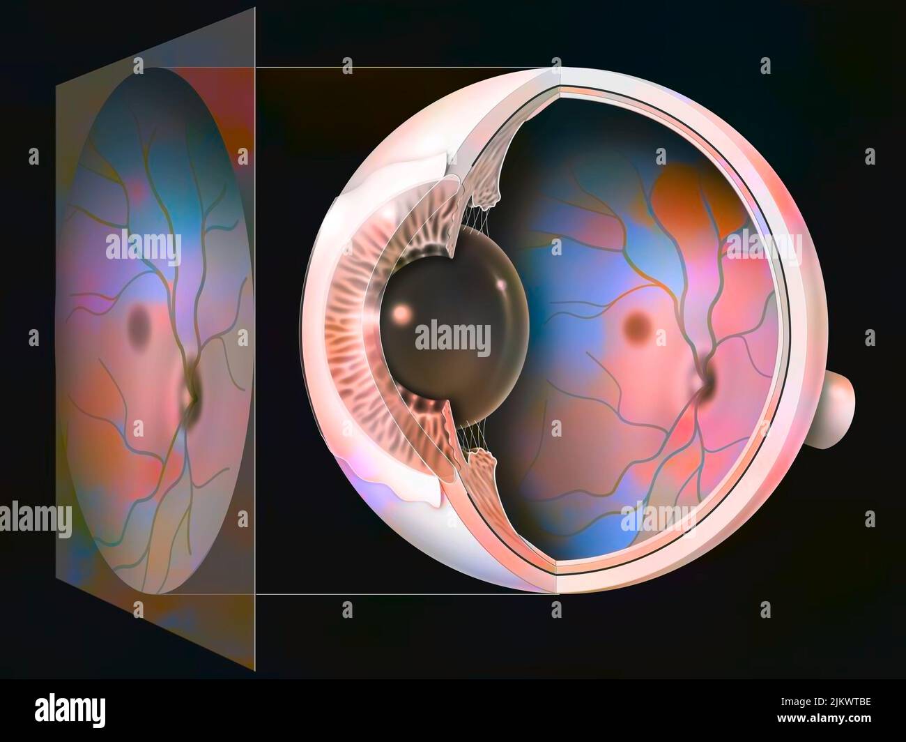 Auge, Glaukom: Untersuchung eines Fundus mit dem Ergebnis. Stockfoto