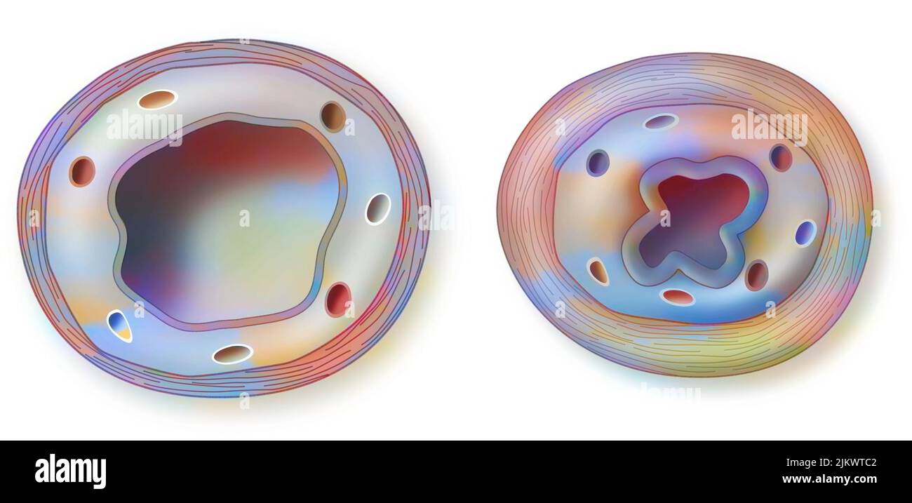 Asthma: Gesunde (links) und entzündete (rechts) Bronchiole. Stockfoto