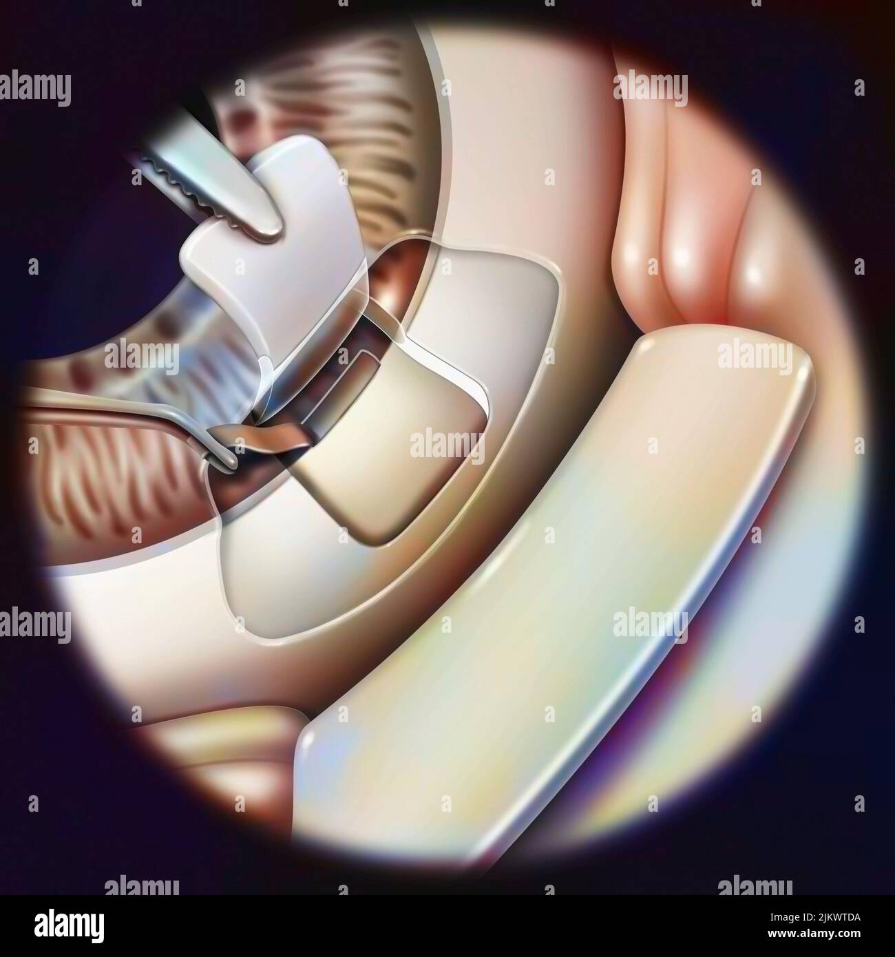 Auge (Glaukom): Sklerektomie mit Entfernung eines kleinen Teils des Trabekulums. Stockfoto