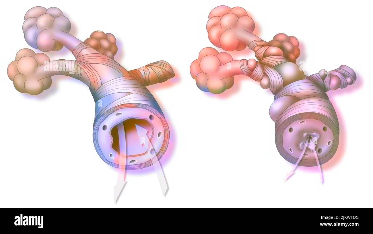 Asthma: Gesunde Bronchiole (links) und Asthmatiker (rechts). Stockfoto