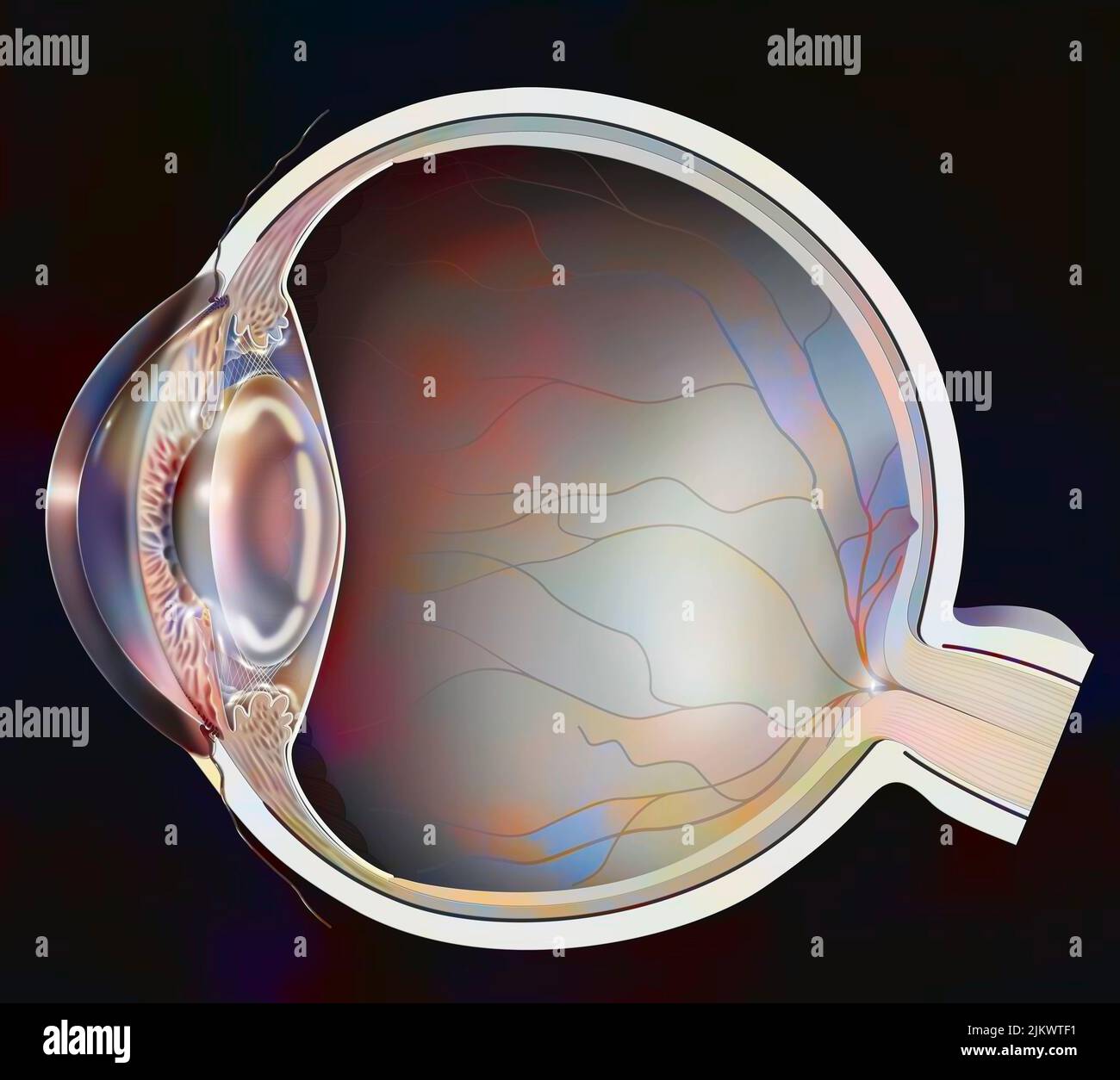 Auge: Trübung der Linse bei kortikalen Katarakten. Stockfoto