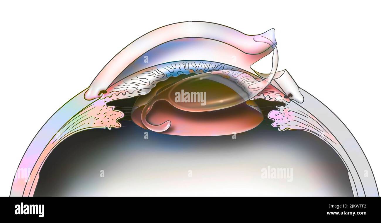 Auge: Platzierung eines intraokularen Implantats zur Behandlung von Katarakten. Stockfoto