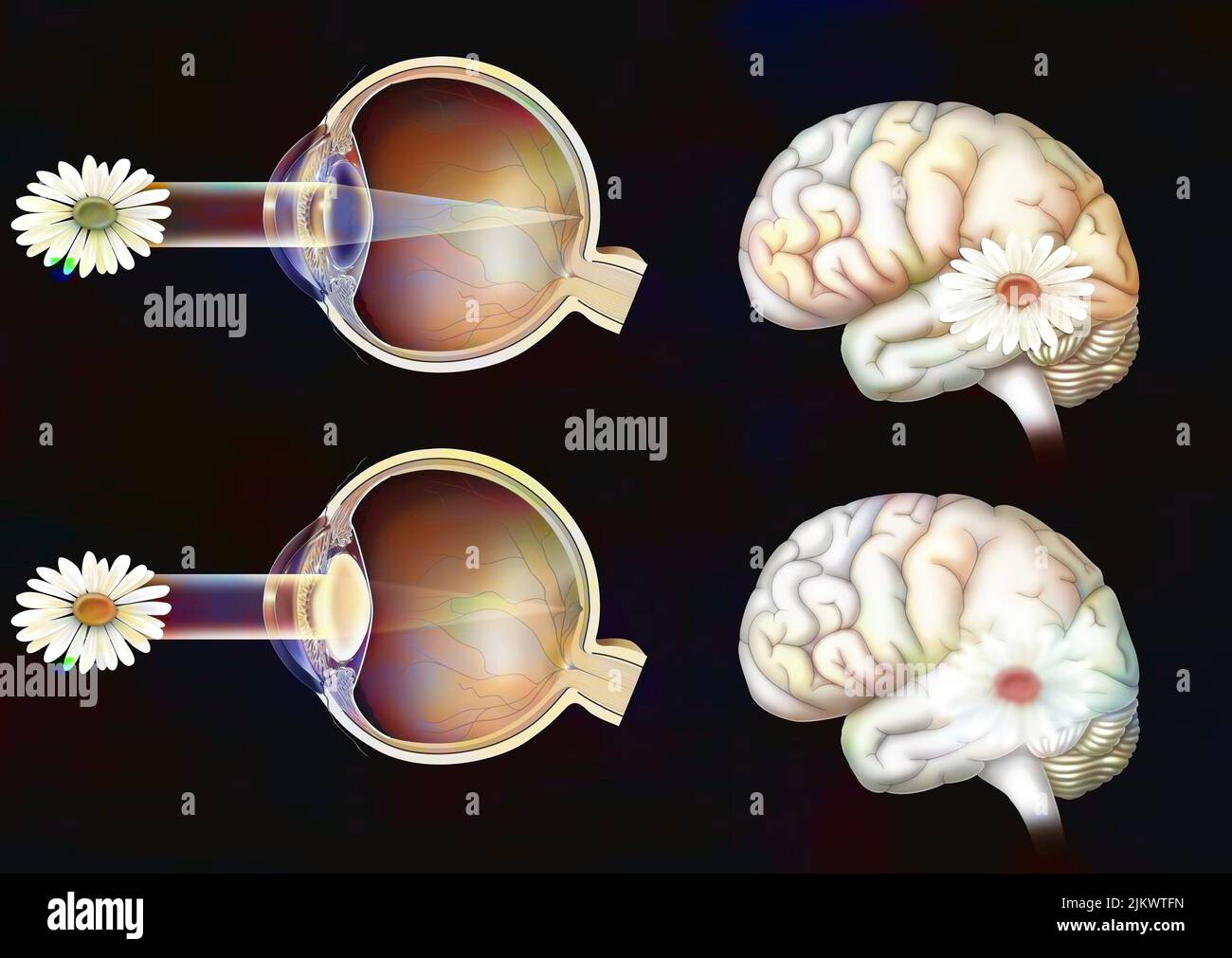 Vergleich zwischen normalem Sehen und dem eines Auges mit Katarakt. Stockfoto