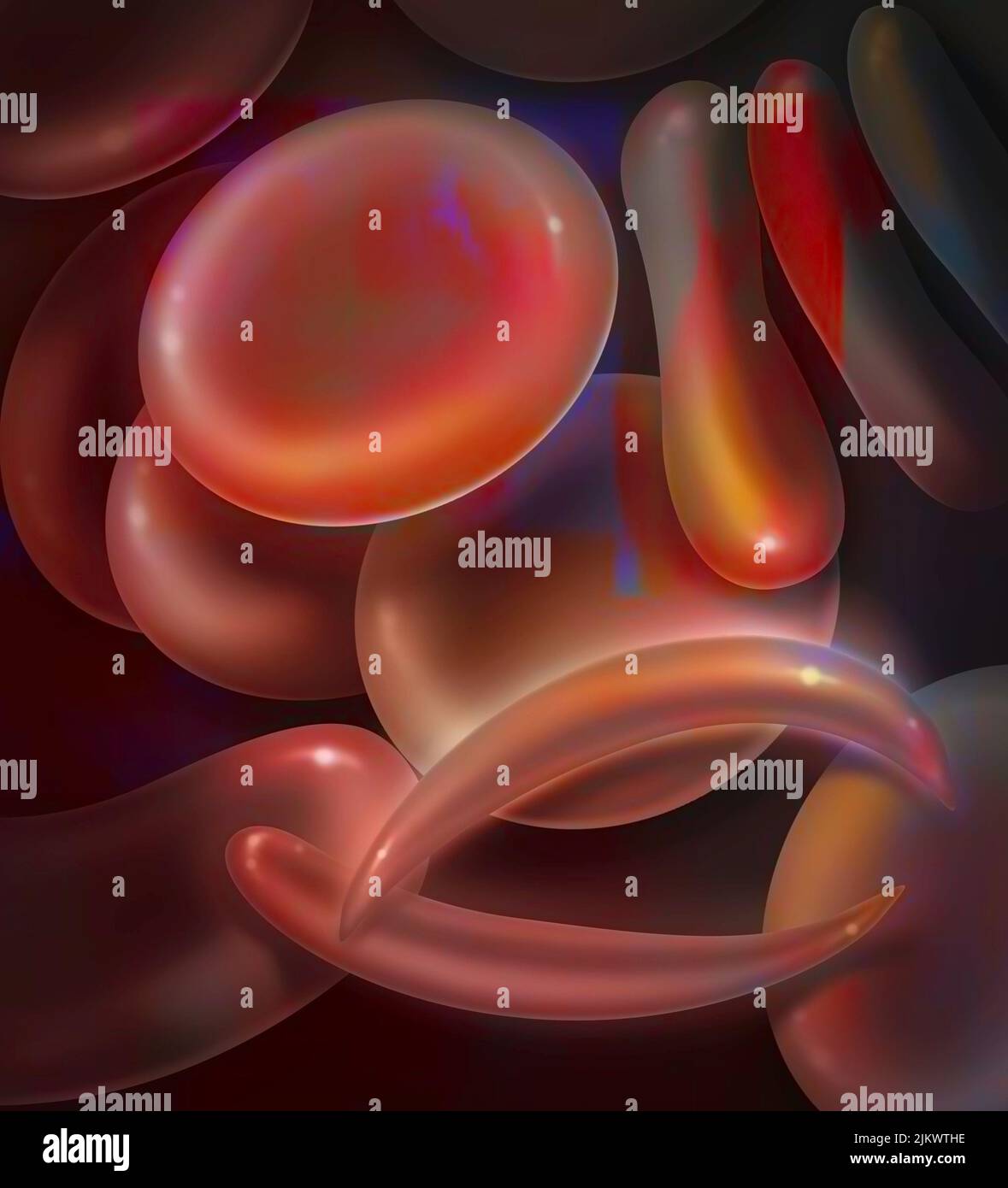Normale rote Blutkörperchen und Sichelzellen (sichelförmige rote Blutkörperchen). Stockfoto