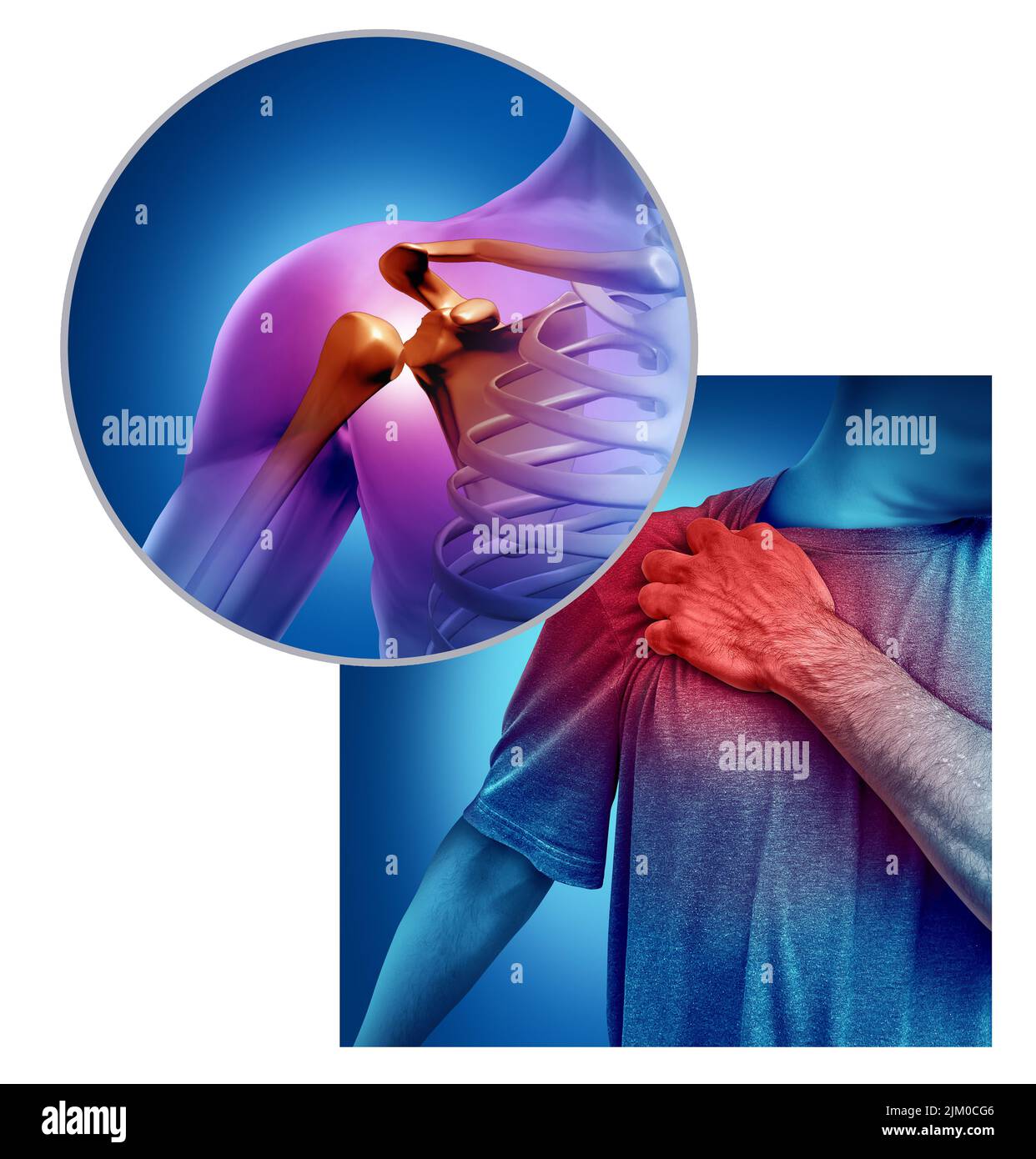 Schulterschmerzen und Schulterverletzungen durch Sportunfall oder Arthritis als Skelettgelenkproblem oder als medizinische Versorgung. Stockfoto