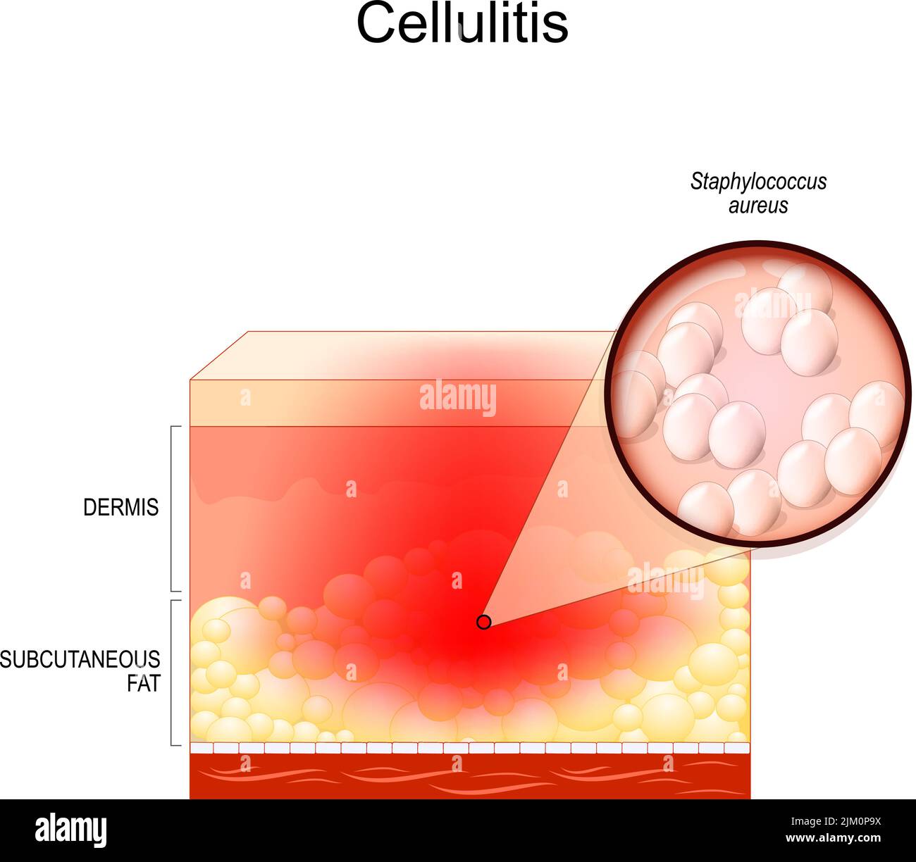 Zellulitis. Querschnitt der Schichten der menschlichen Haut mit Symptomen einer Infektionskrankheit. Nahaufnahme von Staphylococcus aureus. Bakterielle Infektion Stock Vektor