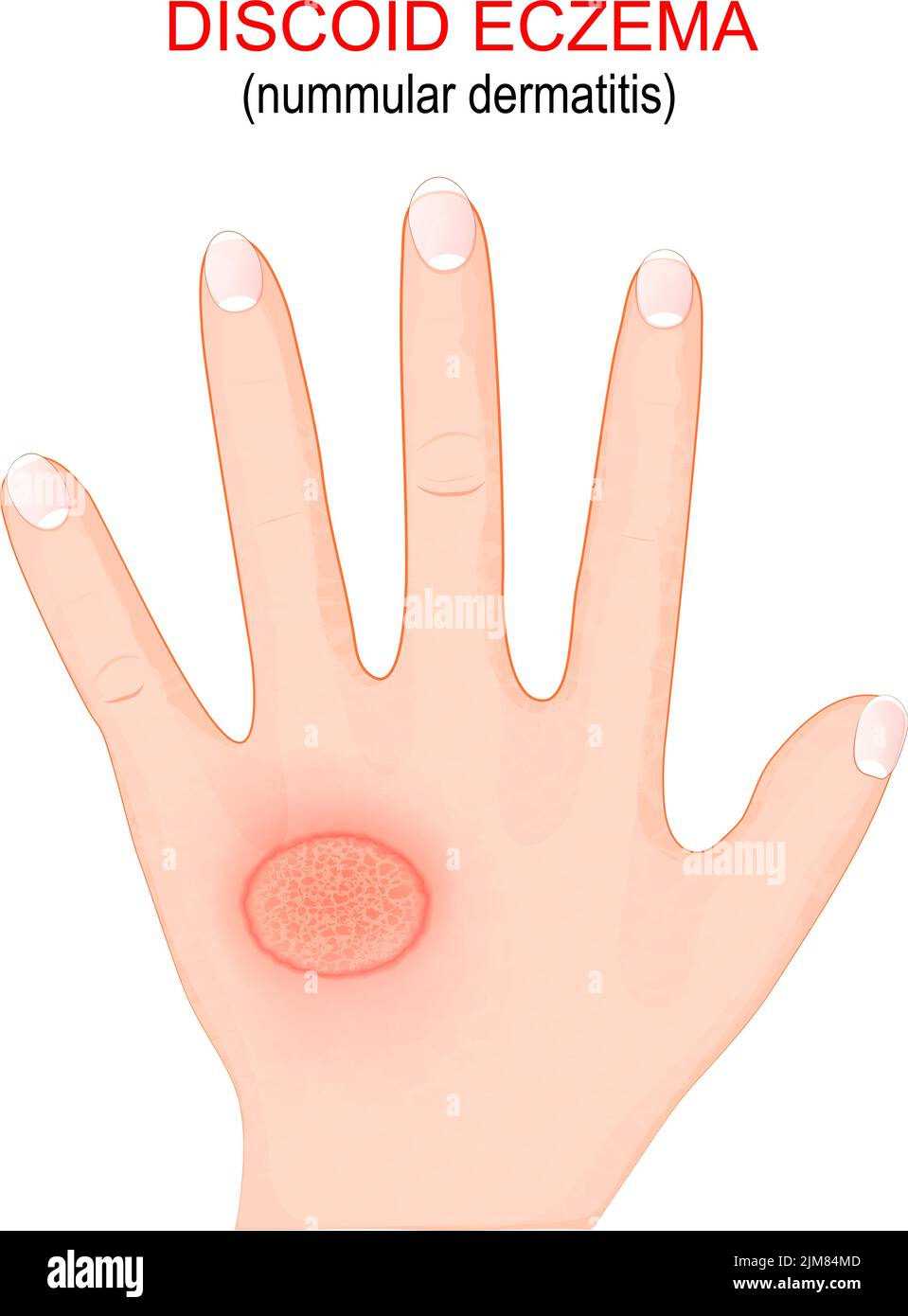 Nummuläre Dermatitis. Diskoides Ekzem ist eine chronische Hauterkrankung, die dazu führt, dass die Haut juckt, geschwollen und in kreisförmigen Flecken rissig wird. Nahaufnahme Stock Vektor