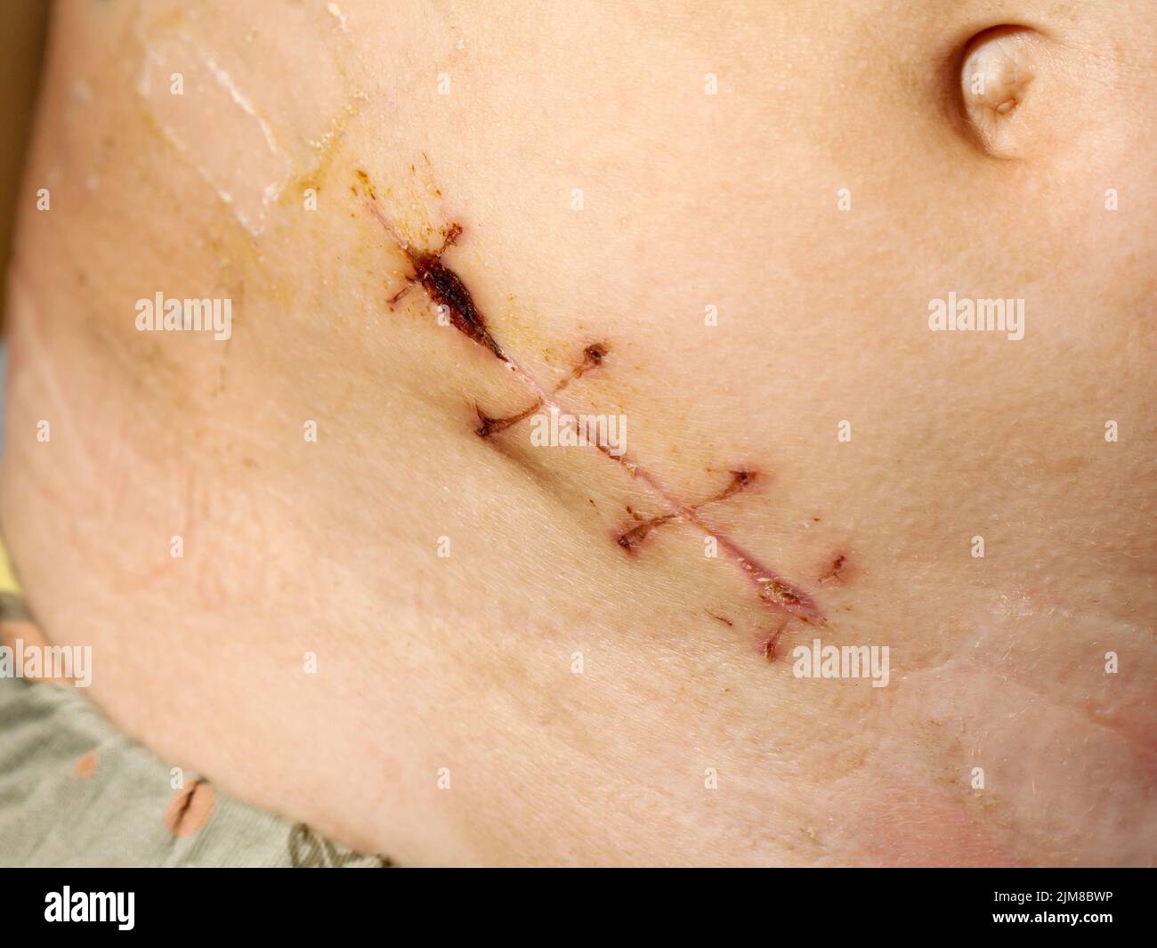 Anhang Entfernung chirurgische Naht Stockfoto