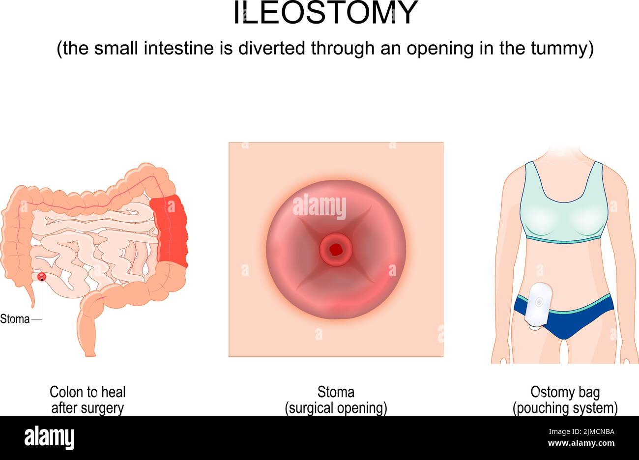 Ileostomie. Der Dünndarm wird durch eine Öffnung im Bauch umgeleitet. Dickdarm nach der Operation zu heilen. Nahaufnahme eines Stoms oder einer chirurgischen Öffnung Stock Vektor