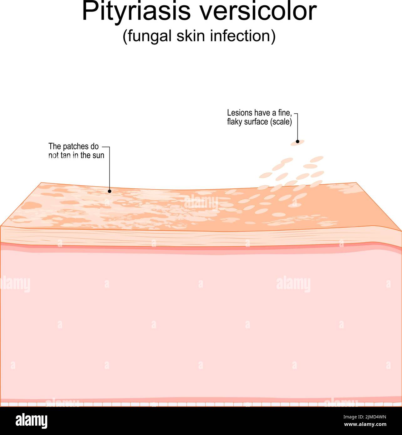 Pityriasis versicolor. Pilzinfektion der Haut. Querschnitt einer menschlichen Haut mit Flecken, die nicht in der Sonne bräunen und Läsionen, die eine feine haben Stock Vektor