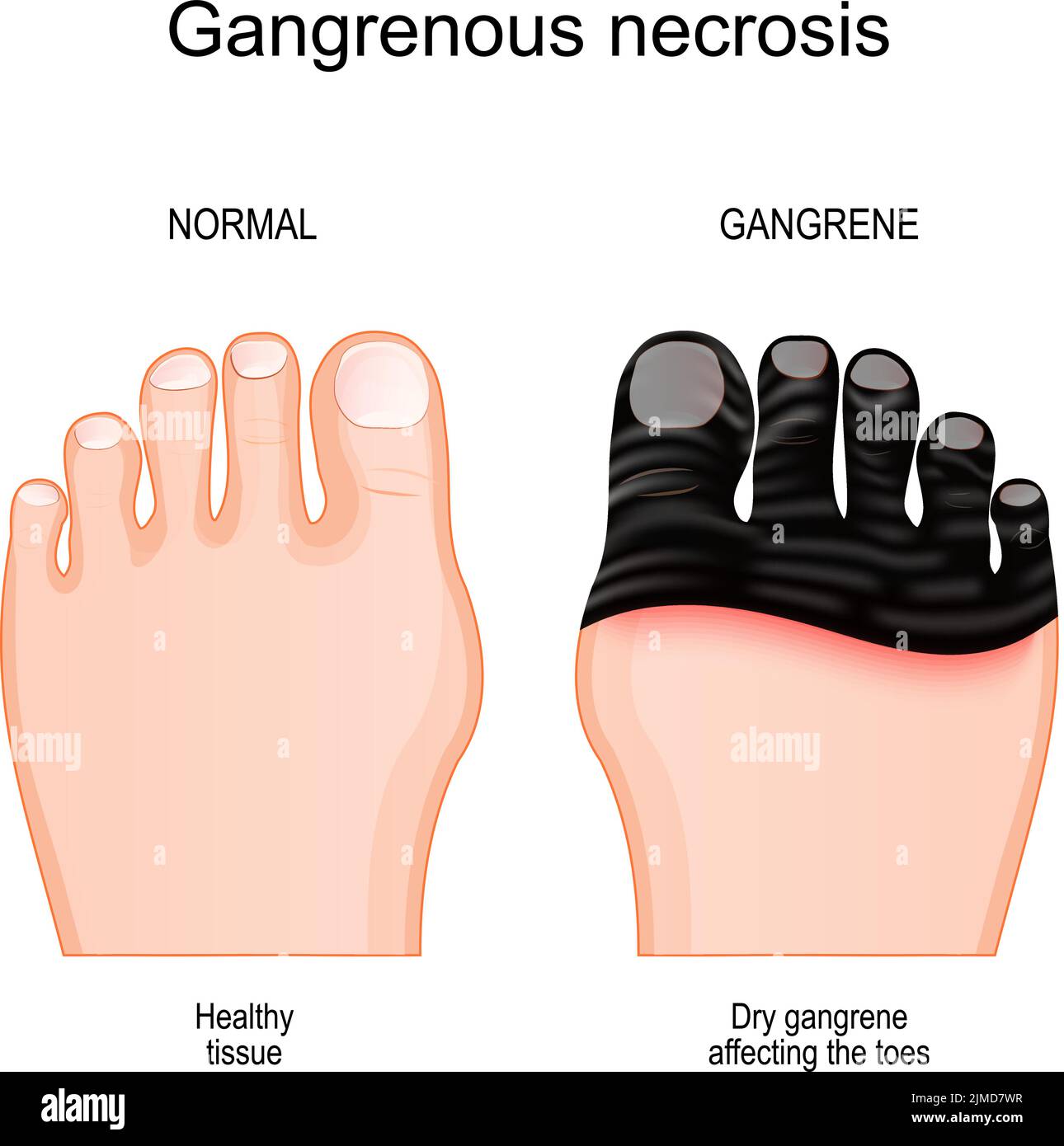 Gangrän. Vergleich und Unterschied zwischen gesundem Fuß und Bein mit Gewebetod durch gangrenöse Nekrose. Trockener Gangrän, der die Zehen beeinflusst. Vektor Stock Vektor