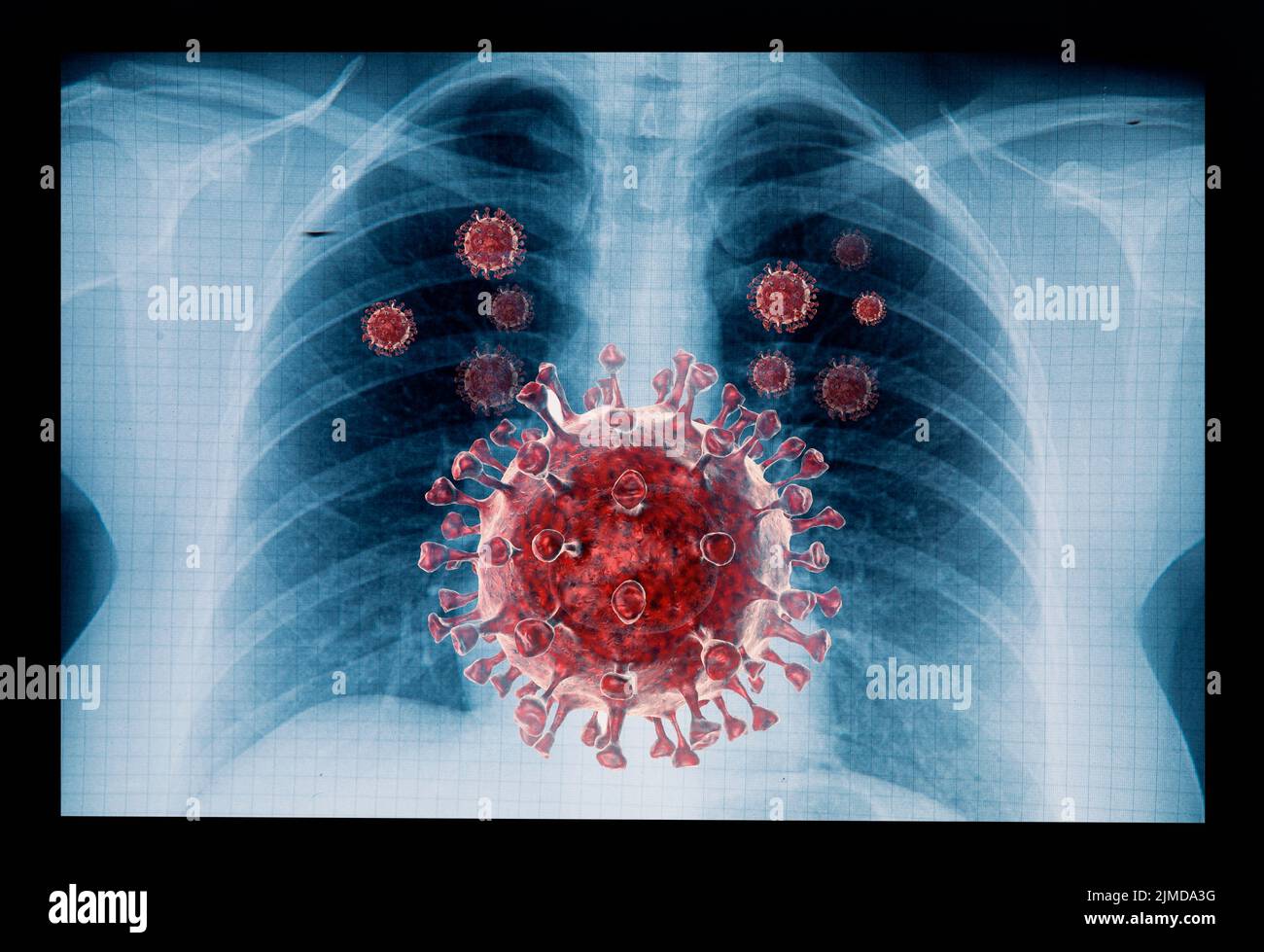 Coronavirus-Krankheit COVID-19-Virusinfektion in der menschlichen Lunge Stockfoto