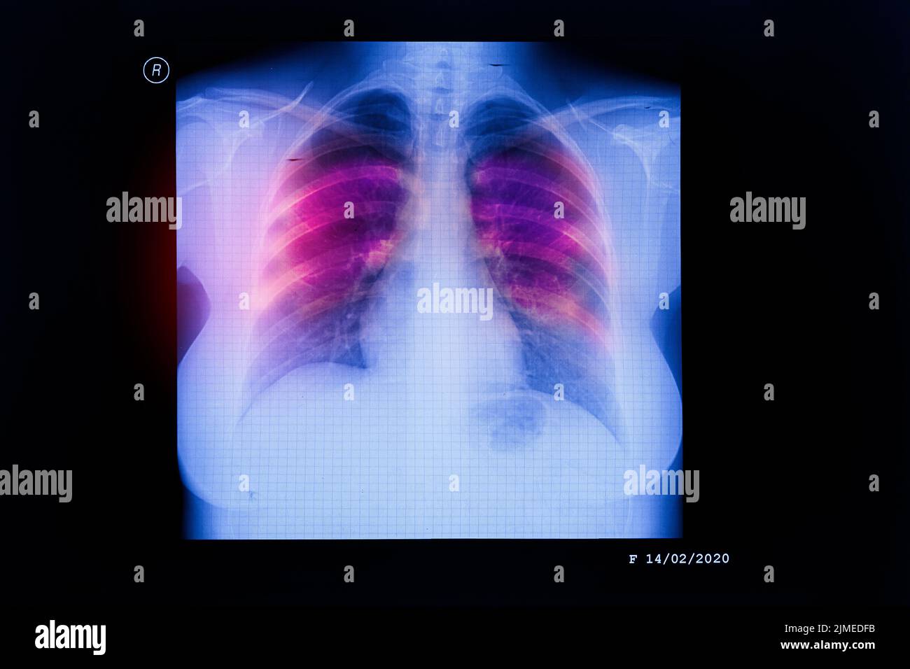 Coronavirus-Krankheit COVID-19-Virusinfektion in der menschlichen Lunge Stockfoto