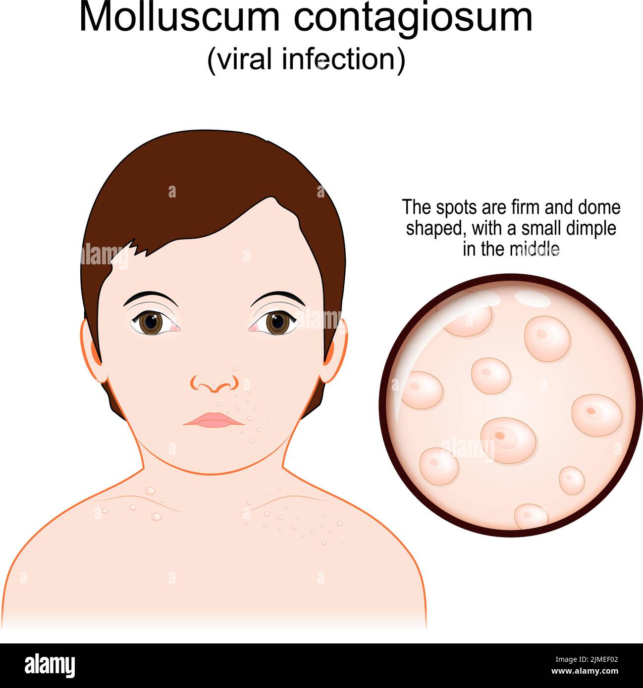 Molluskum contagiosum. Wasserwarzen ist eine Virusinfektion, die die Flecken auf der Haut verursacht Zustand. Vektorposter. Stock Vektor