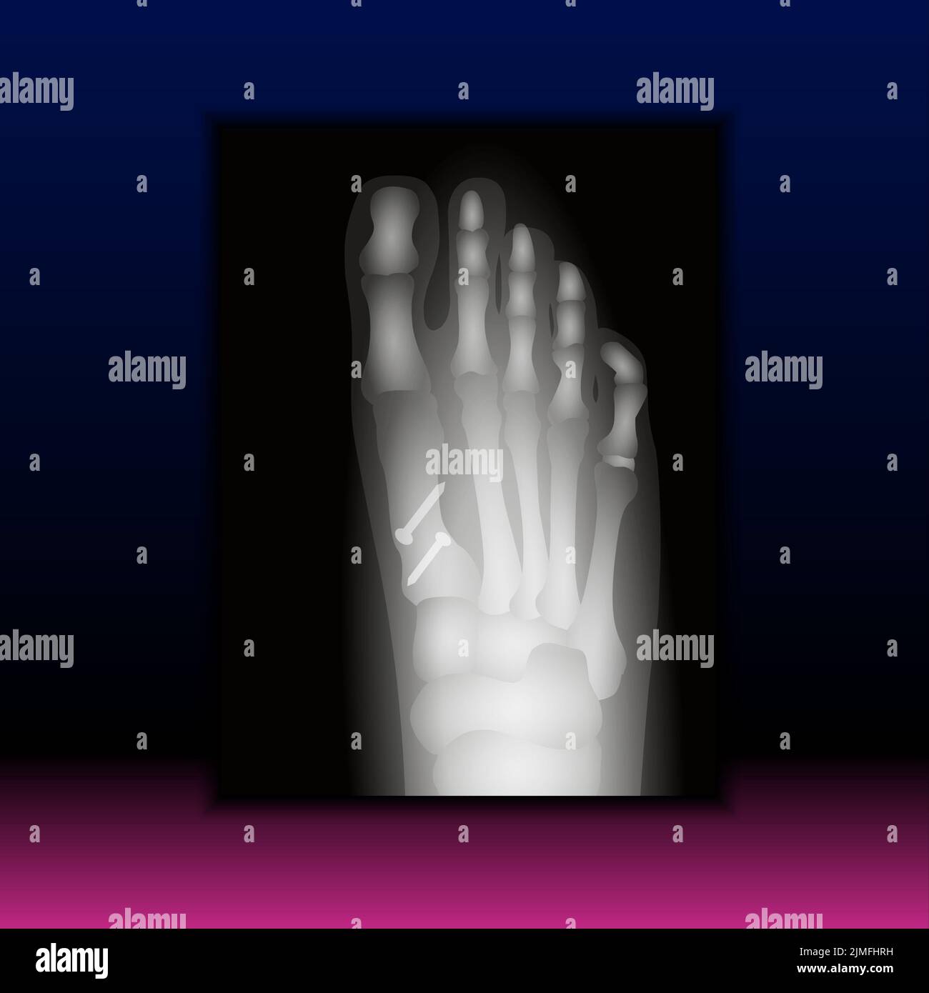 Röntgenaufnahme des Fußes Stockfoto