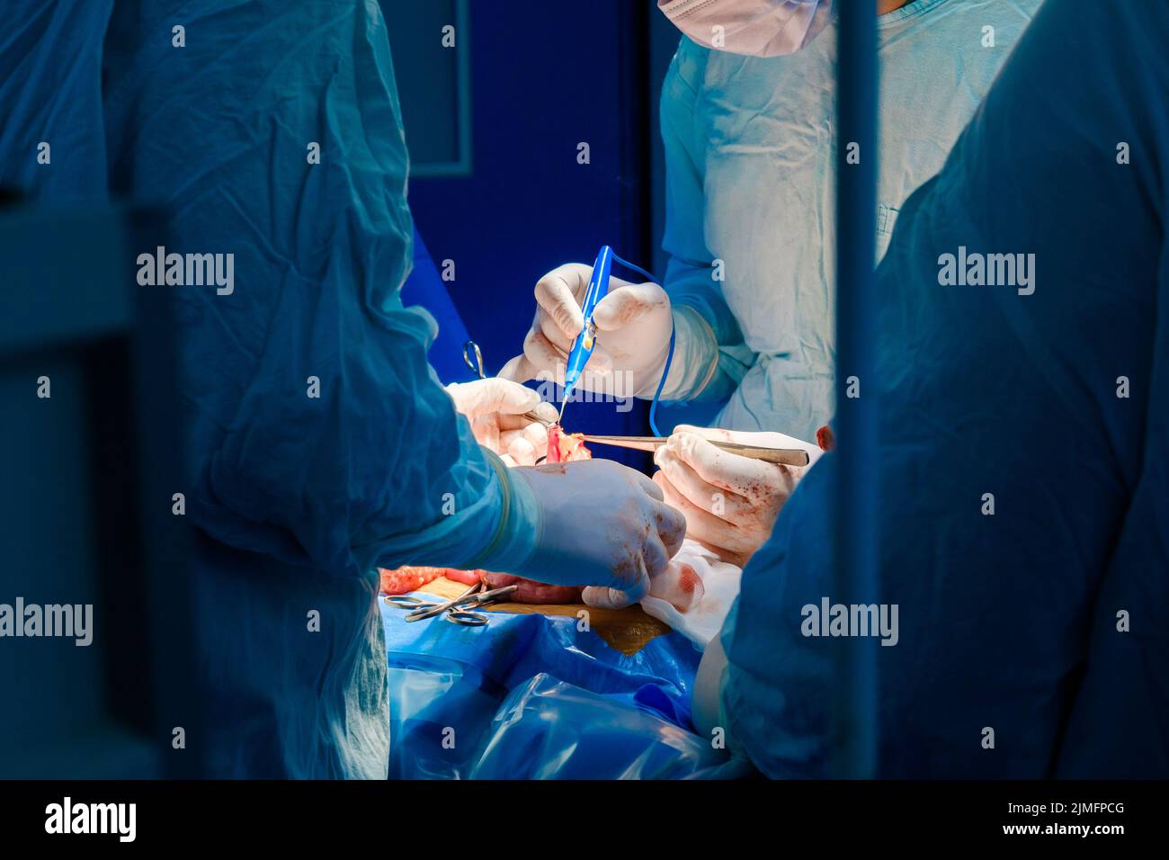 Die Hände von Chirurgen in sterilen Handschuhen arbeiten mit einem Elektrokoagulator. Stockfoto