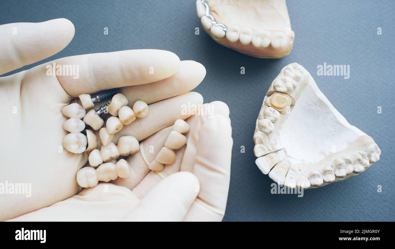 Kieferorthopädische Reparatur keramische Zähne Implantate Hände Stockfoto