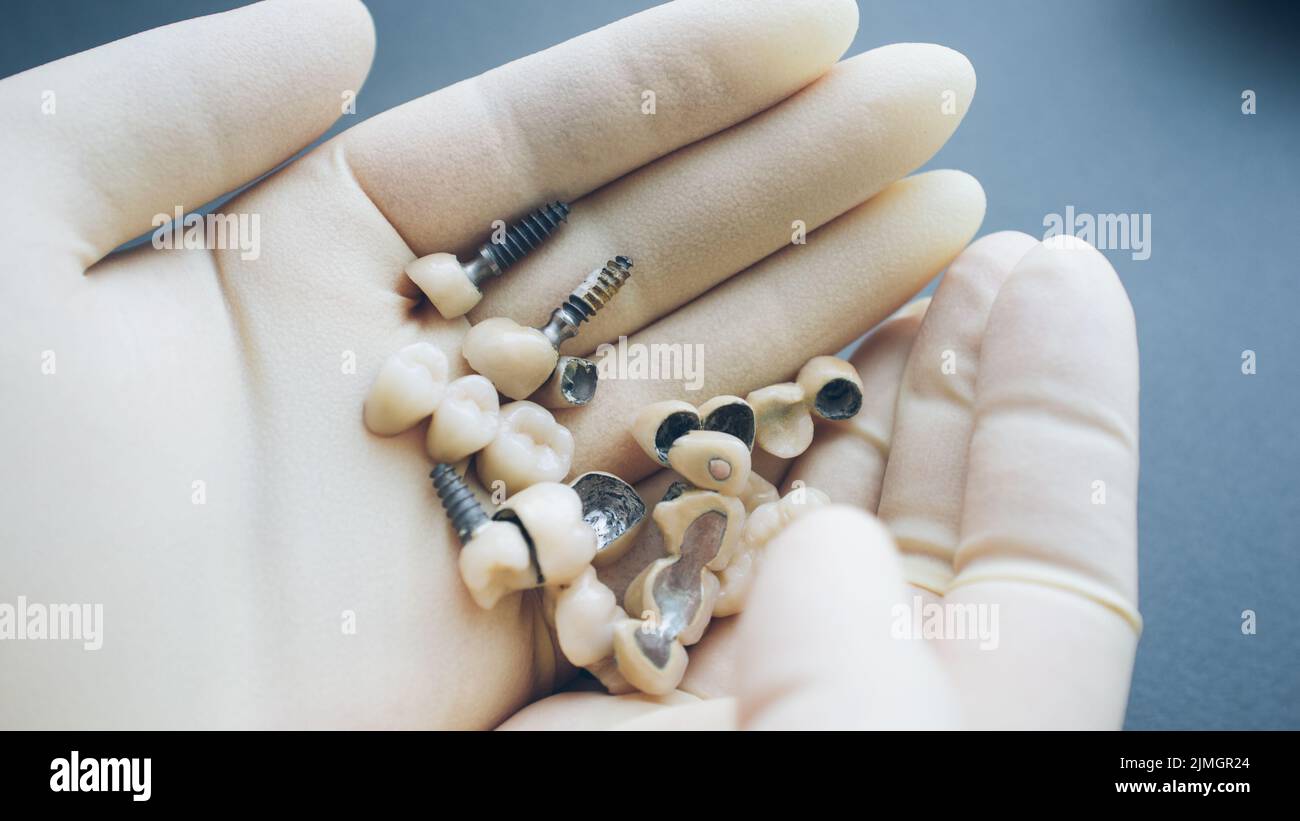 Zahnrekonstruktion Zahnkeramische Implantate Hände Stockfoto