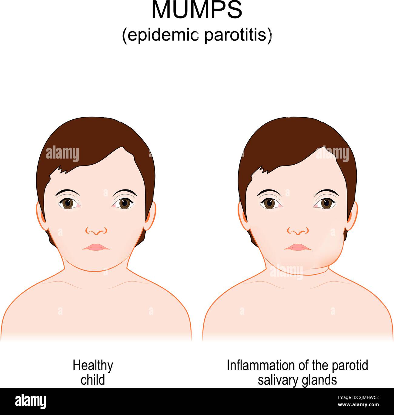 Mumps. Epidemische Parotitis. Viruserkrankung, die durch das Mumps-Virus verursacht wird. Vergleich und Unterschied zwischen einem gesunden Kind und einem Jungen mit Entzündung Stock Vektor