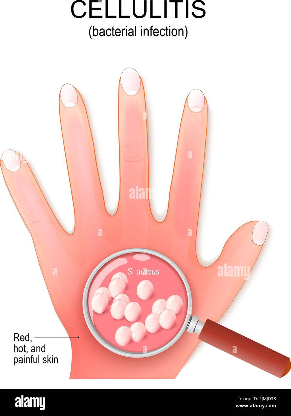 Zellulitis. Die Handfläche des Menschen mit einer bakteriellen Infektion. Nahaufnahme der Bakterienkolonie. Lupe und Staphylococcus aureus. vektorgrafik Stock Vektor