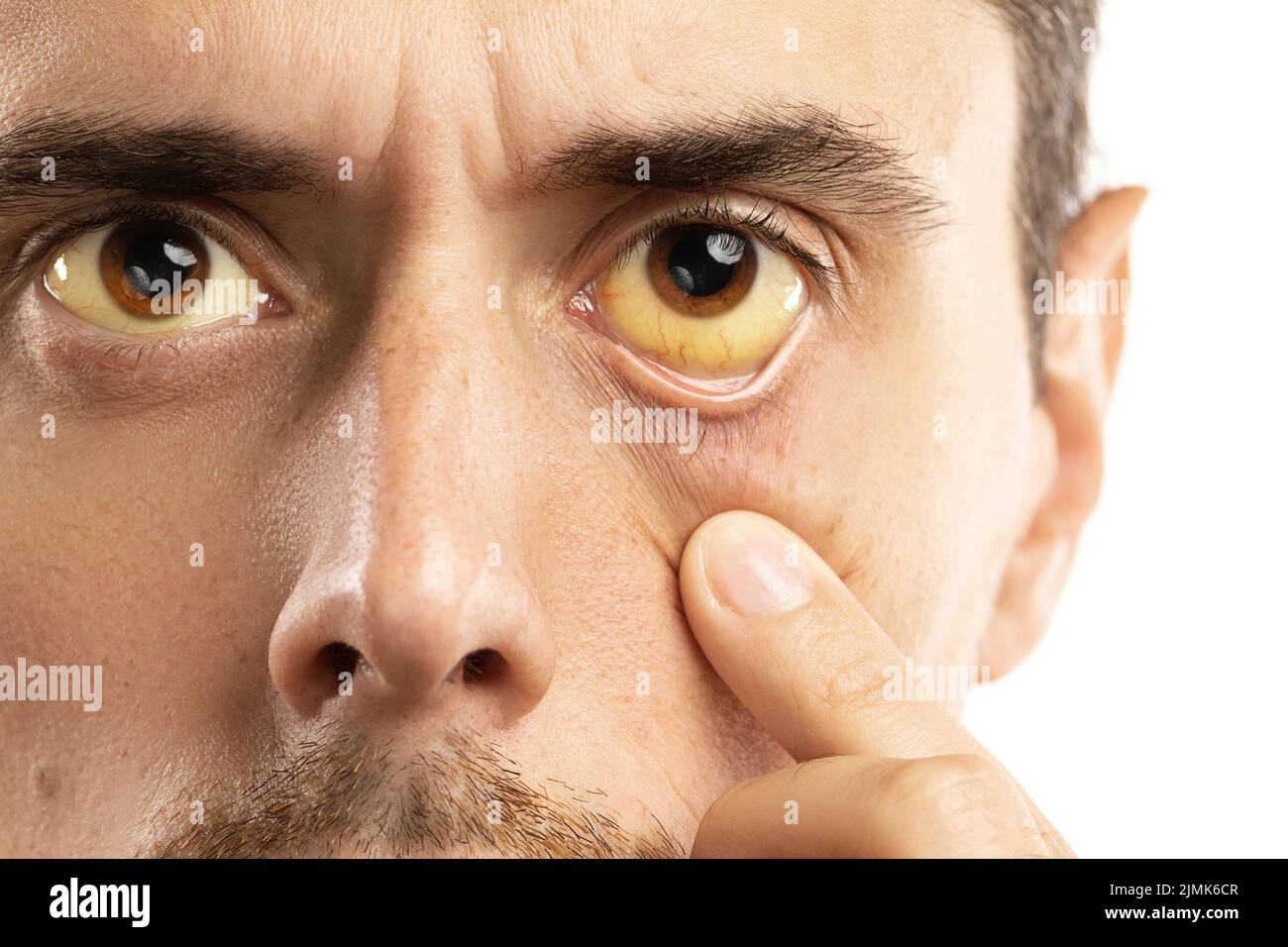 Gelbliche Augen sind Anzeichen für Leberprobleme, Virusinfektionen oder andere Krankheiten Stockfoto