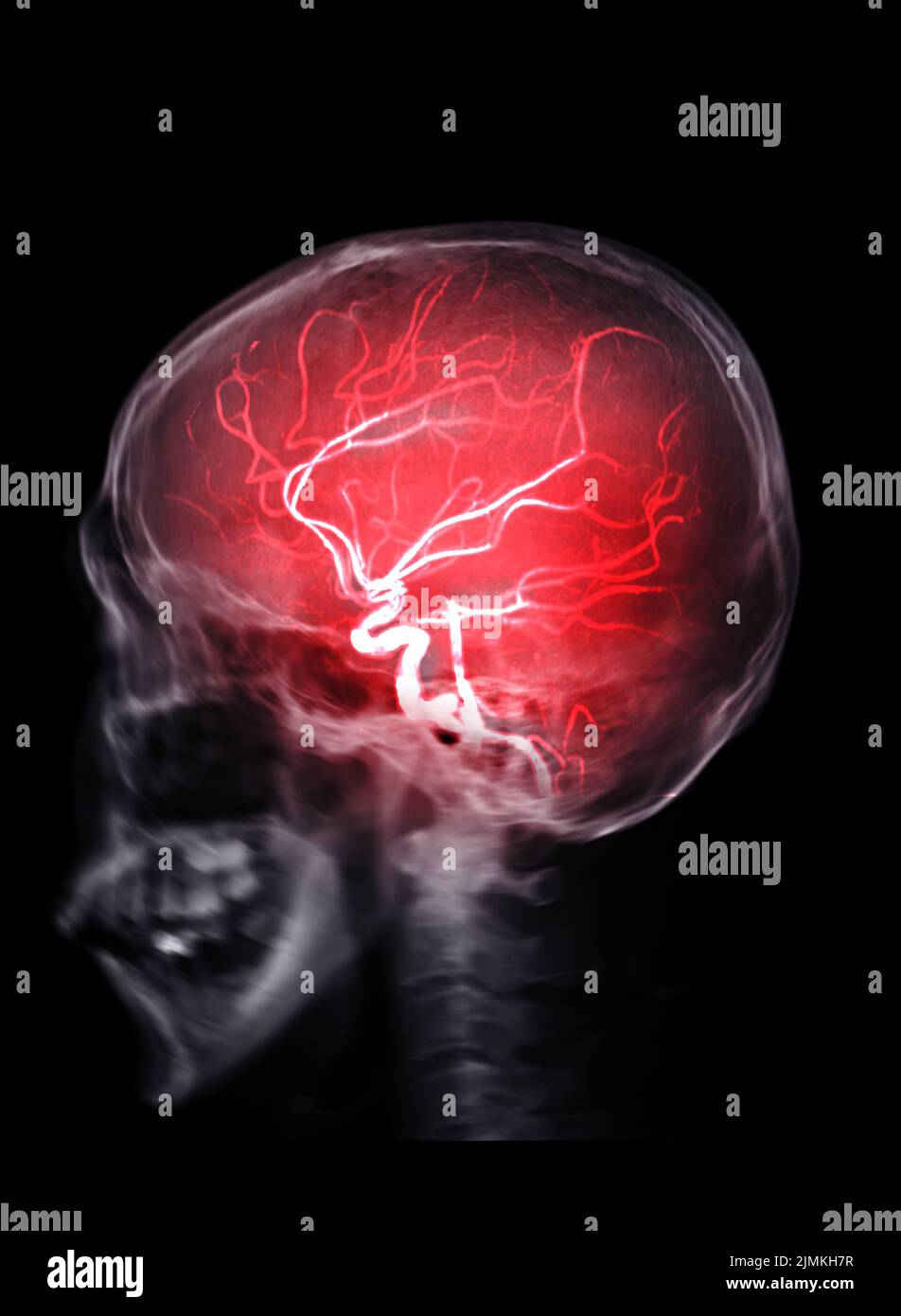 Schädelbildfusion mit MRI MRA Brain zur Beurteilung von Stenose und Schlaganfallerkrankungen. Stockfoto