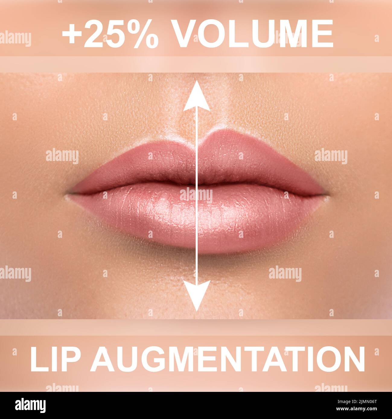 Vergleich der weiblichen Lippen nach Augmentation mit Füllstoff-Injektionen Stockfoto