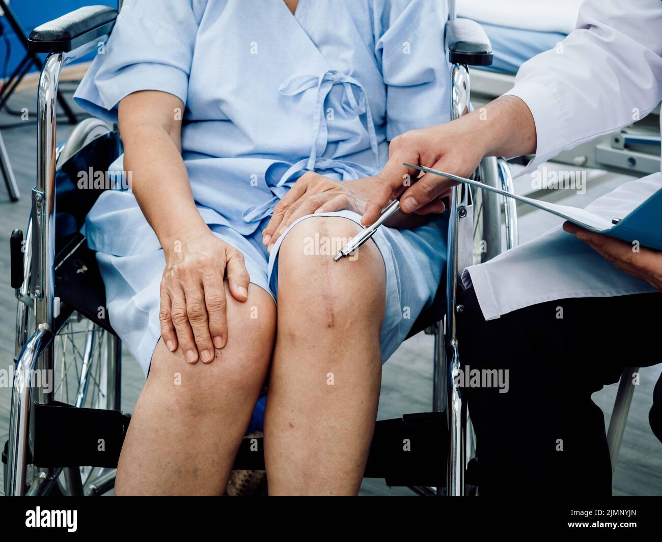 Knieoperation Narbe. Nahaufnahme Narben chirurgischer totaler Kniegelenkersatz bei älterer oder älterer alter Frau, die auf dem Rollstuhl sitzt und mit einem Federkrümmen zeigt Stockfoto