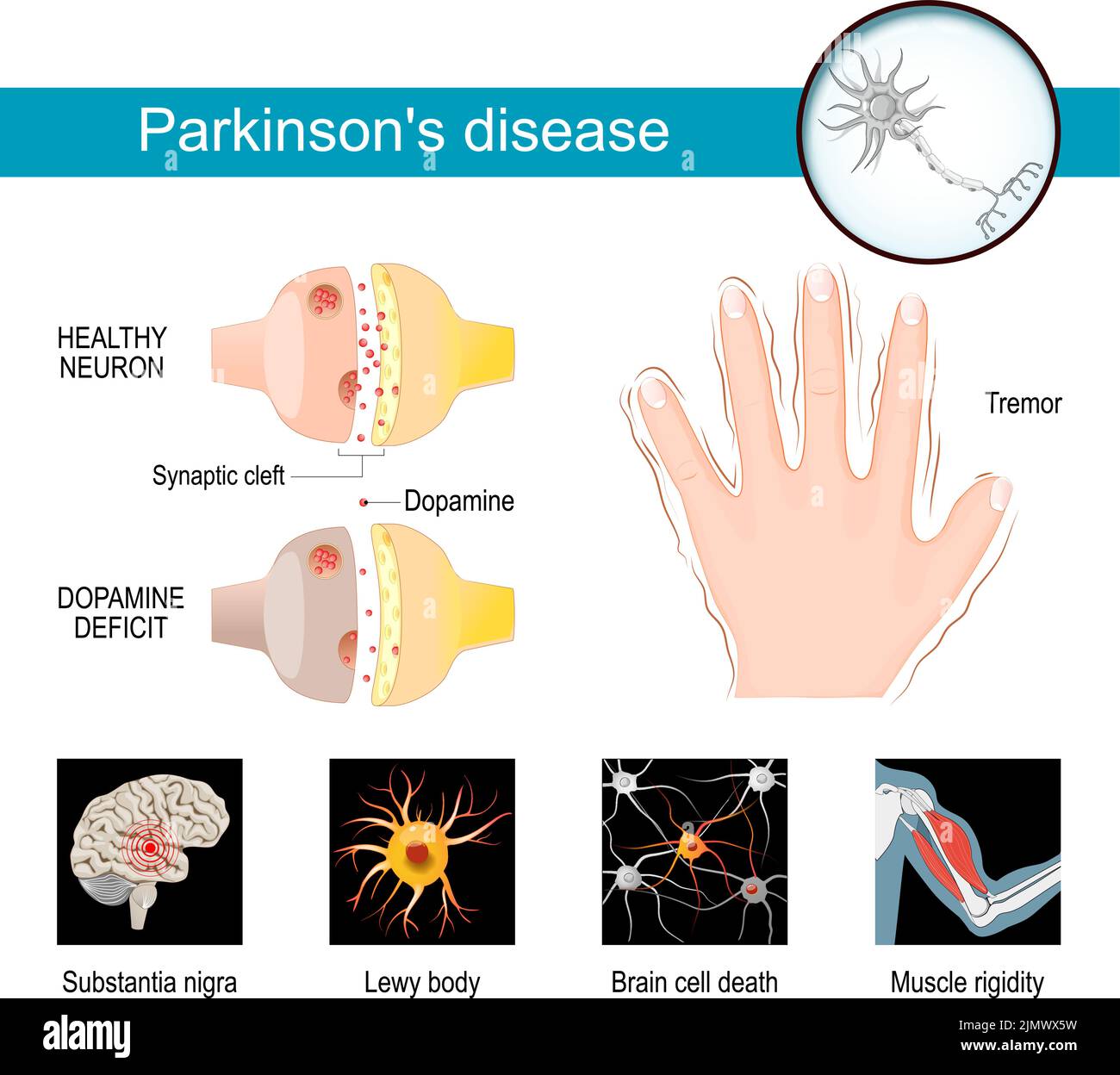 Infografik zur Parkinson-Krankheit. Gesunde Neurone und synaptische Spalte mit Dopamindefizit. Symptome eines Parkinsonismus. Zittern oder Händeschütteln. Muskel Stock Vektor