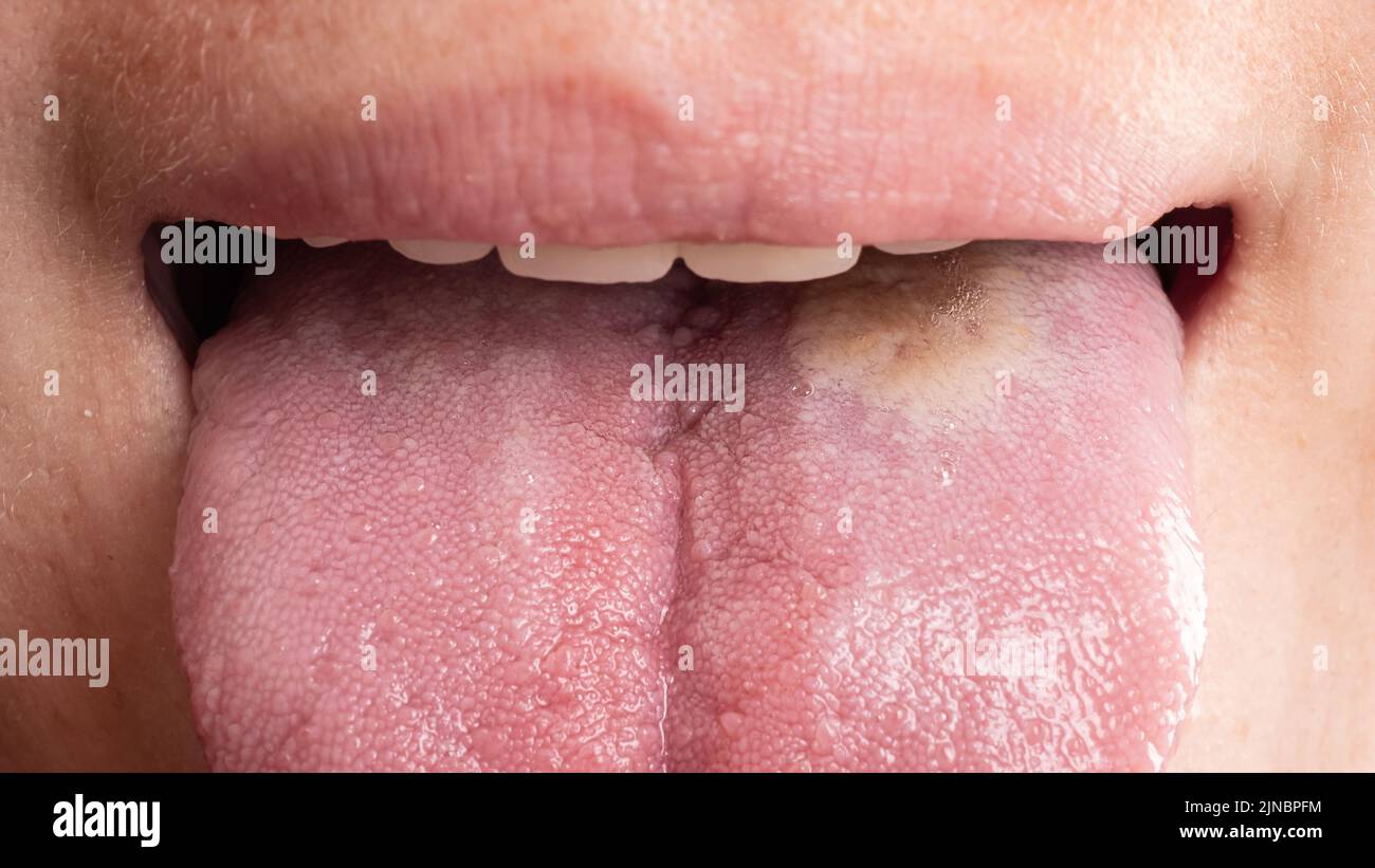 Stomatitis Entzündung der Zunge, Krebs der Zunge Nahaufnahme Stockfoto