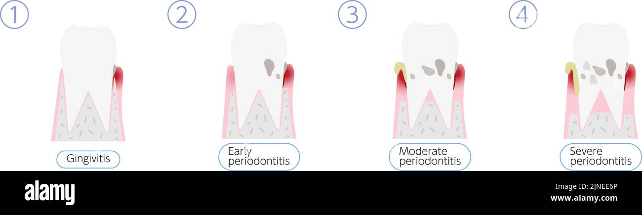 Darstellung des Fortschreitens der Parodontitis, 4 Stufen Übersetzung: Gingivitis, frühe Parodontitis, mäßige Parodontitis, schwere Parodontitis Stock Vektor