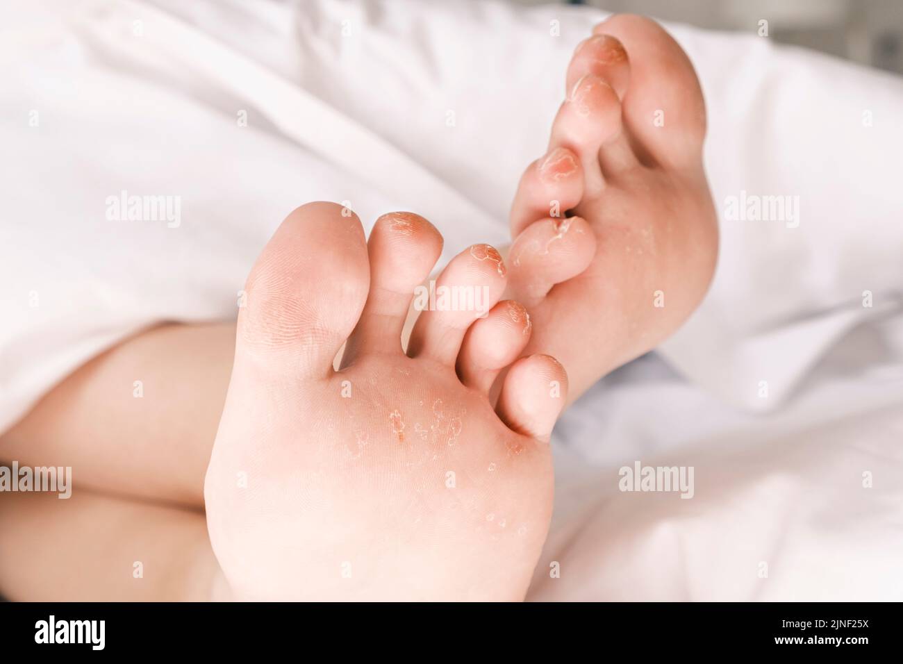 Hühneraugen und Mykose. Nahaufnahme der Frauenfüße mit Schwielen an jedem Finger. Rissige Haut an den Beinen, Entzündungen und Rötungen. Hautprobleme Stockfoto