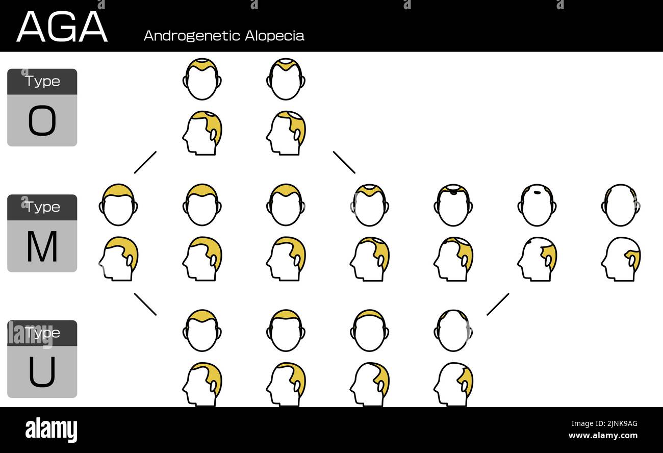 Darstellung jeder Art von AGA-androgenetischer Alopezie und des Fortschrittstadiums Stock Vektor