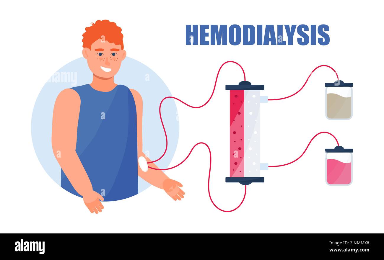 Vektor des Hämodialysekonzepts. Methode der extrarenalen Blutreinigung bei akuter und chronischer Niereninsuffizienz. Nephrologe behandelt, Nieren testen. Stock Vektor