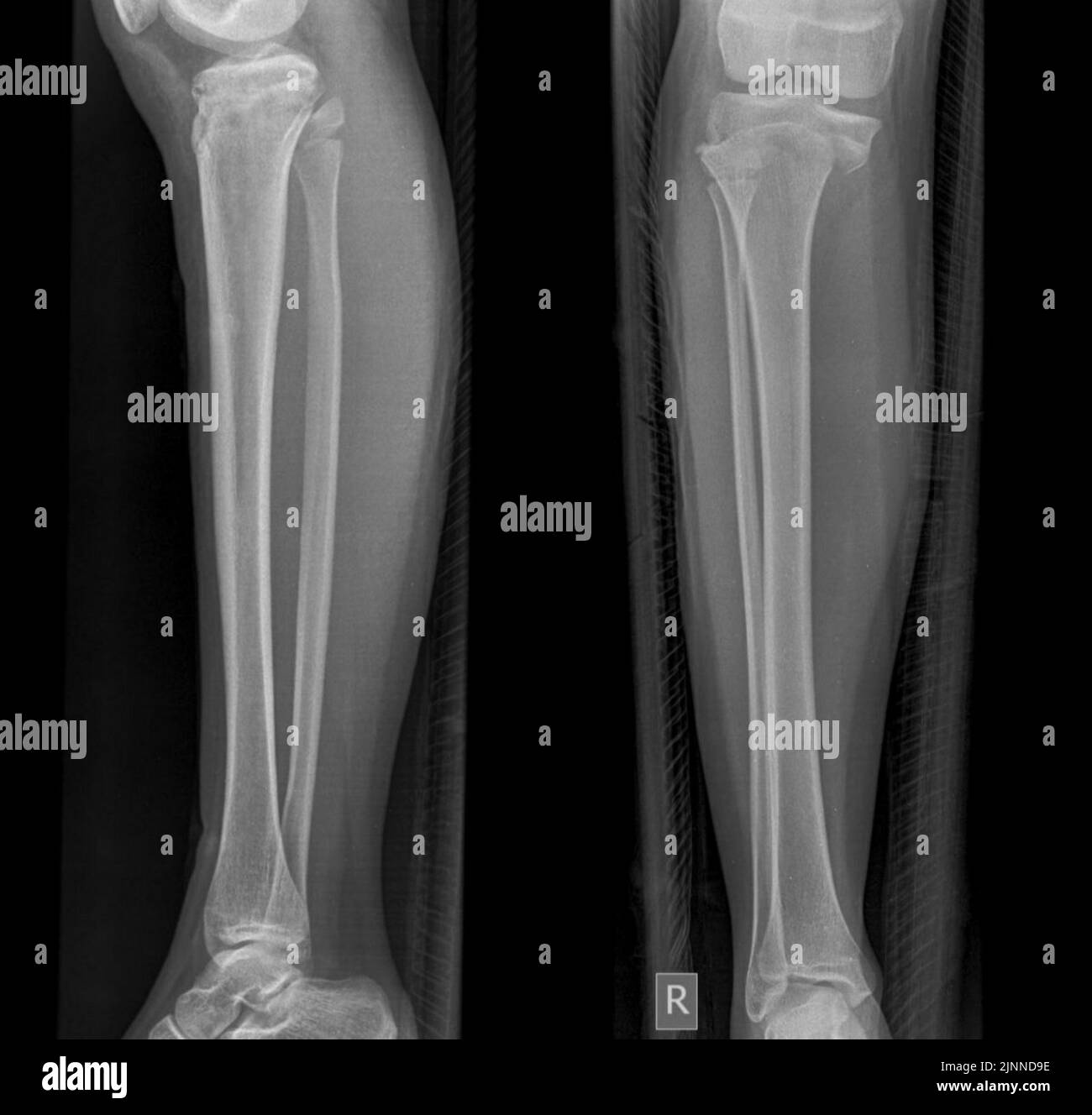Bruch der Wachstumsplatte, Röntgen Stockfoto