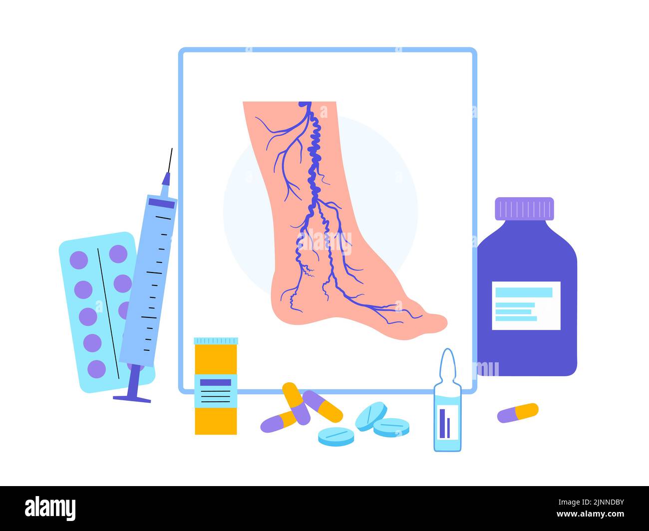 Behandlung der Krampfadern, Illustration Stockfoto