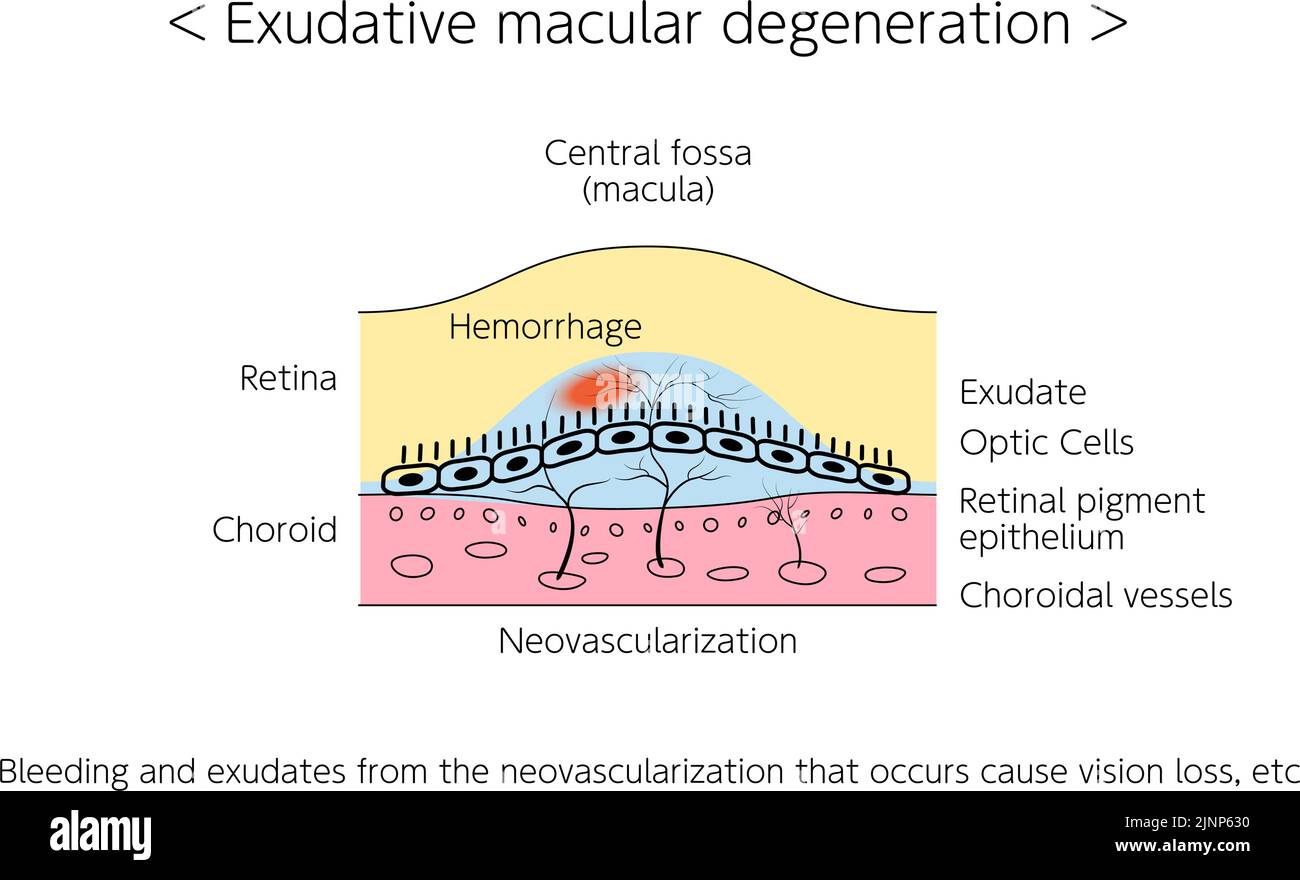 Augenerkrankungen, Exsudative Altersbedingte Makuladegeneration Illustriert Stock Vektor