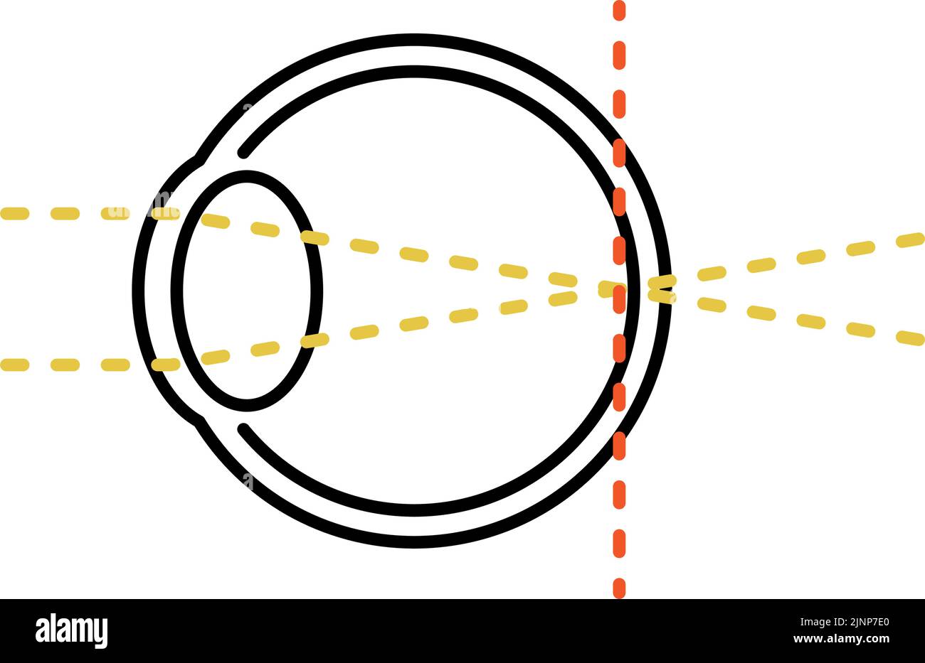 Medizinische Illustration von Sehschärfe und refraktiver Störung, Orthopädie (Fokus auf der Netzhaut) Stock Vektor