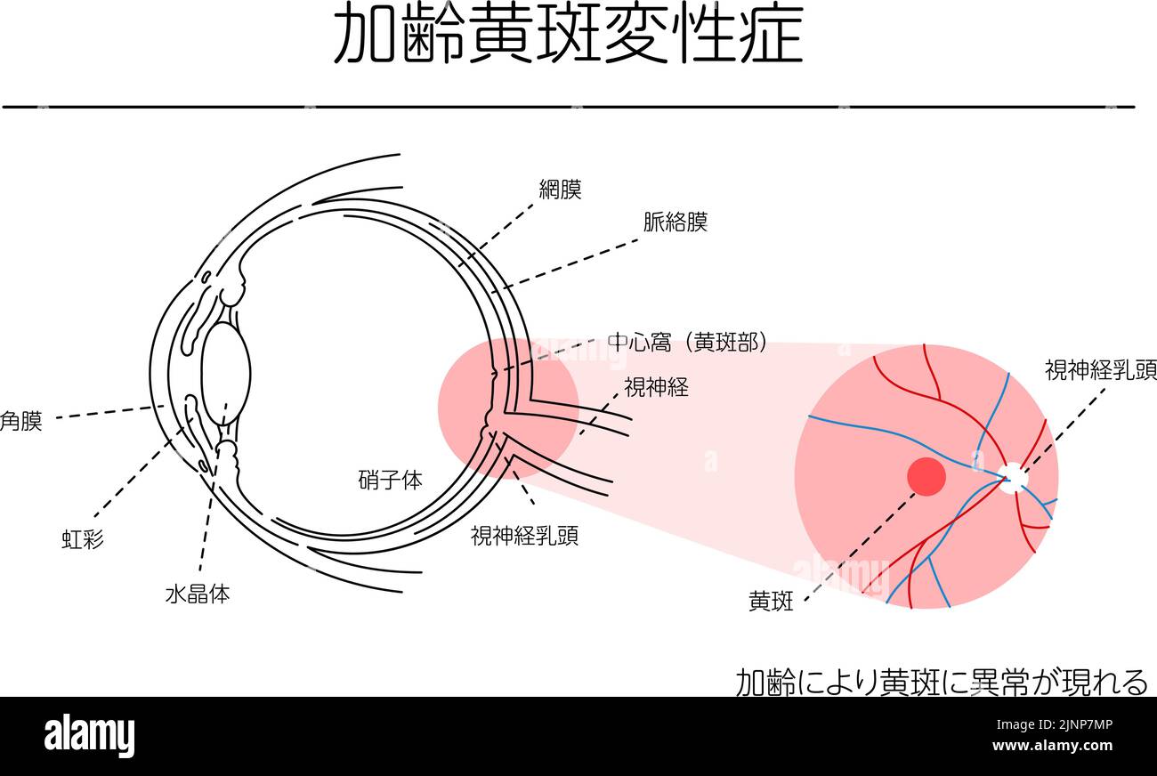 Darstellung von Augenerkrankungen, altersbedingter Makuladegeneration - Übersetzung: Altersbedingte Makulaanomalien, Hornhaut, Iris, Linse, Glaskörper, Netzhaut, Stock Vektor