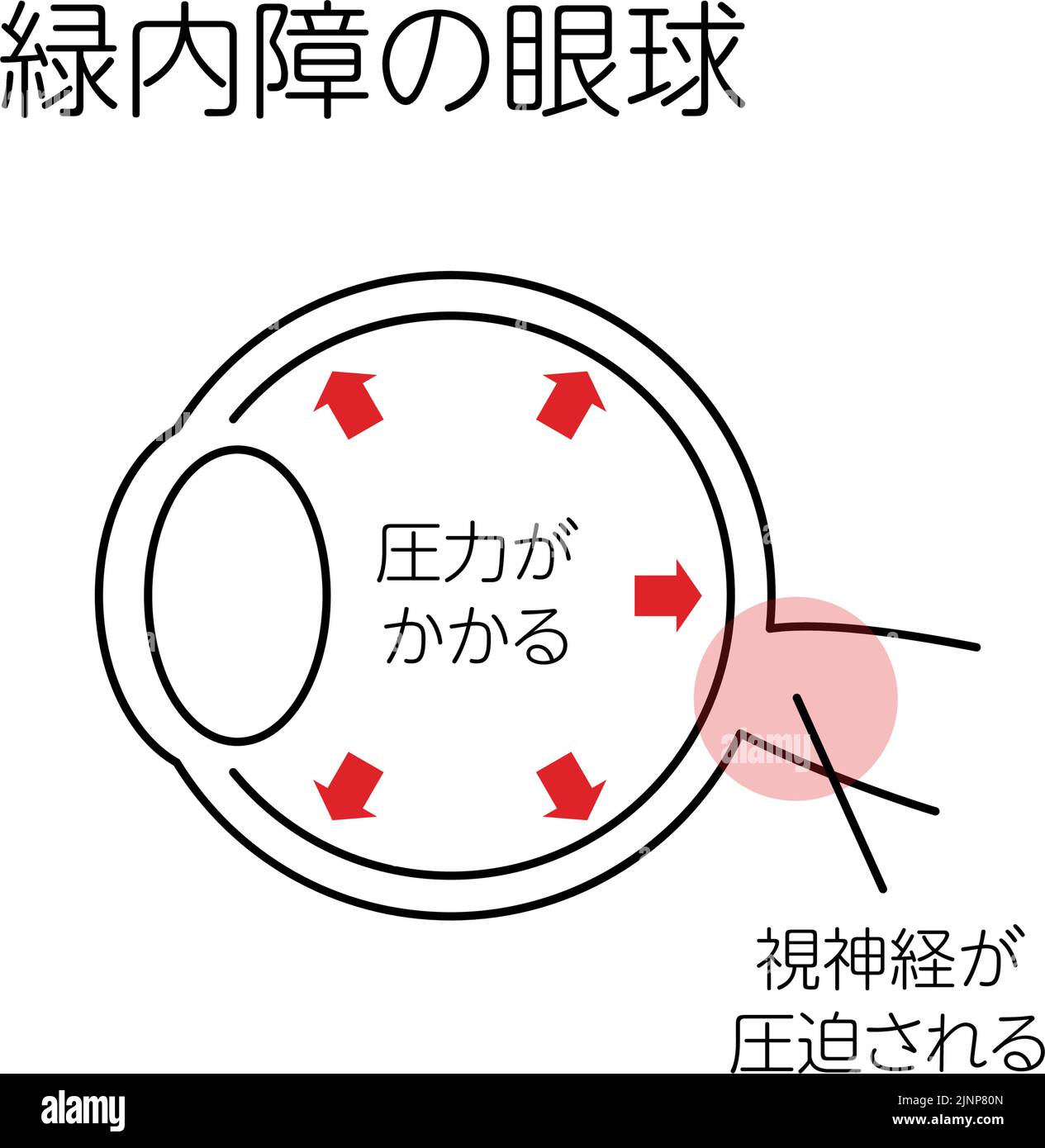 Illustration der Funktionsweise des Glaukoms, Glaukomauge, medizinische Illustration - Übersetzung: Glaukomauge, Druckaufbau, Kompression des Sehnervs Stock Vektor