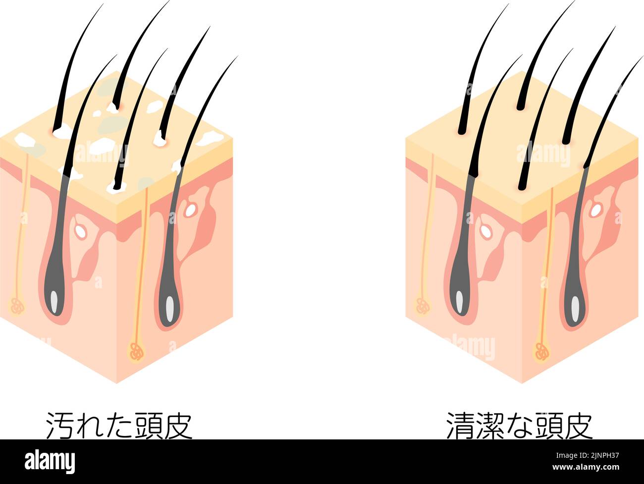 Diagrammatische Darstellung eines Querschnitts einer schmutzigen und einer sauberen Kopfhaut, isometrisch - Übersetzung: Schmutzige Kopfhaut, saubere Kopfhaut Stock Vektor